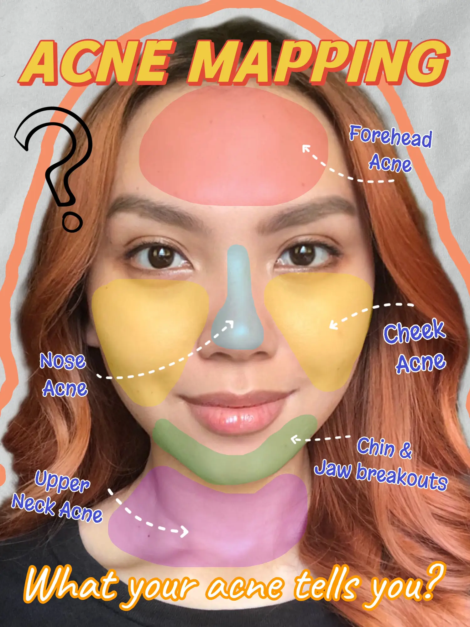 acne diagram of the face