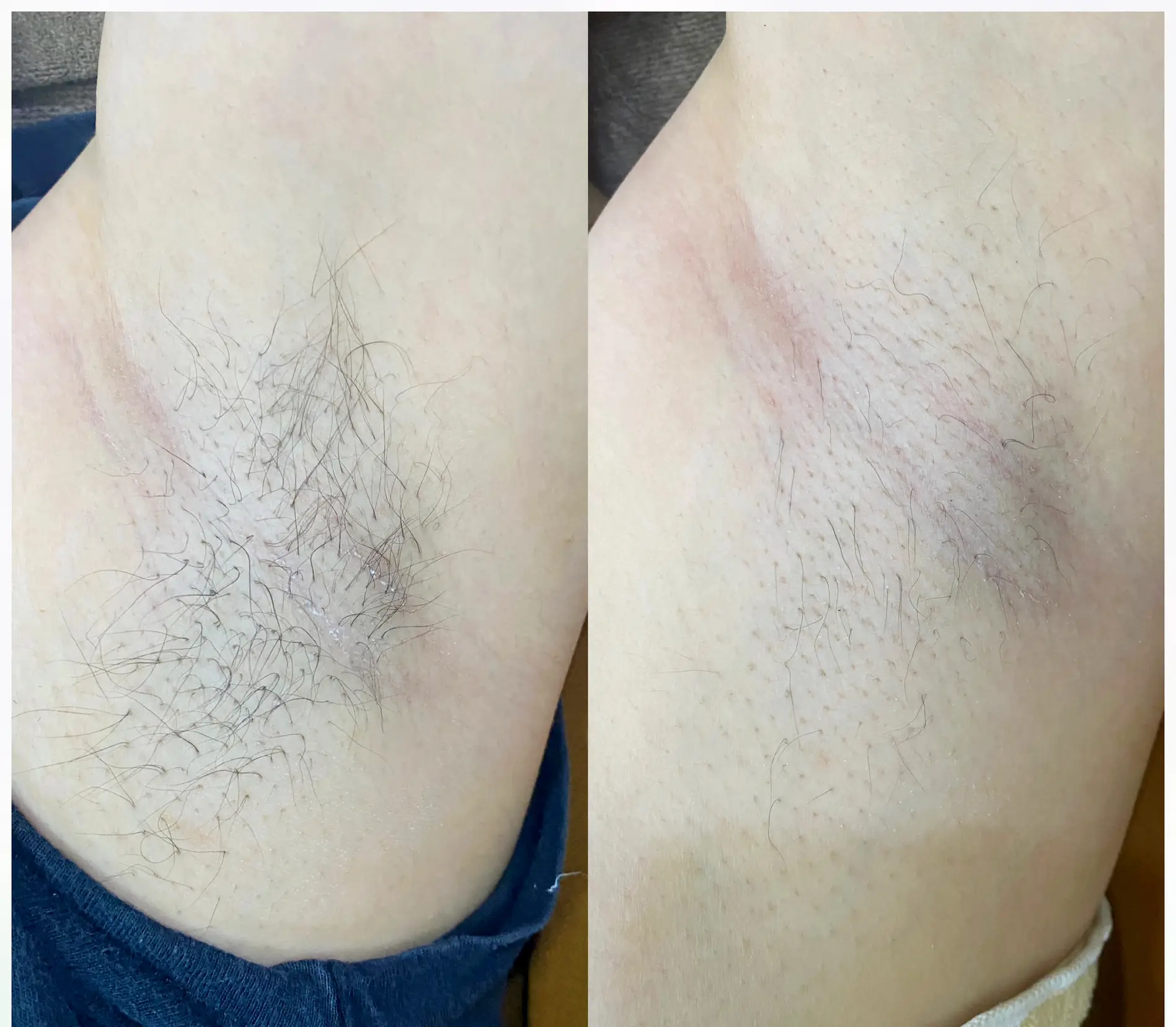 Armpit Hair Removal Laser Review Gallery posted by Neeya