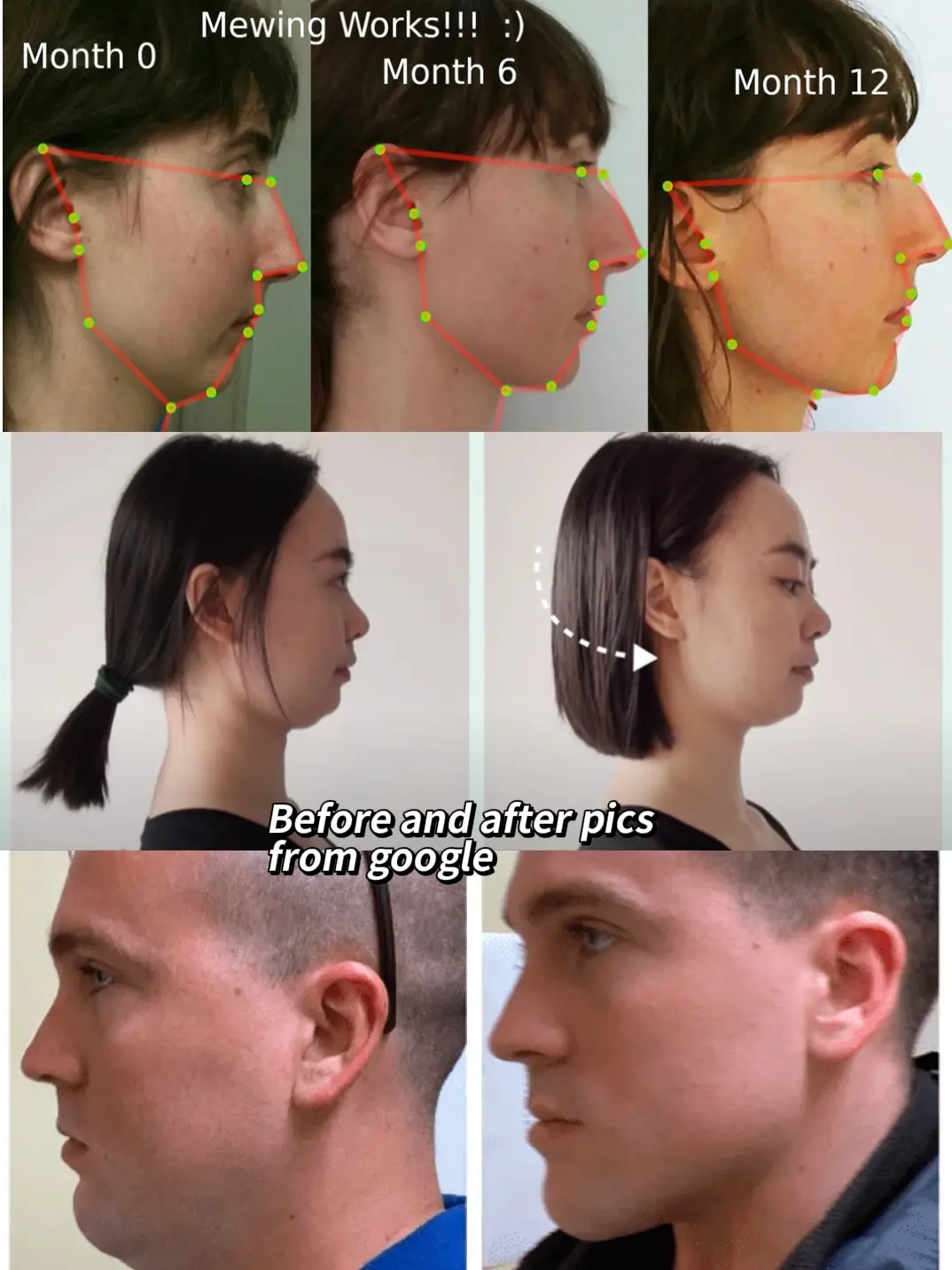 Mewing: Before and After the Jawline Defining Trick