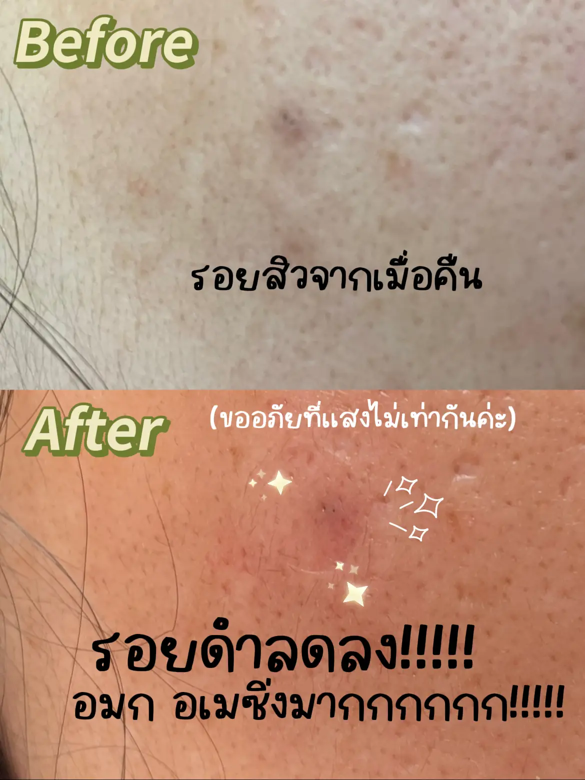 รีวิวแผ่นแปะลดรอยสิว Curesys Dark Spot AC Patch | แกลเลอรีที่โพสต์โดย ...