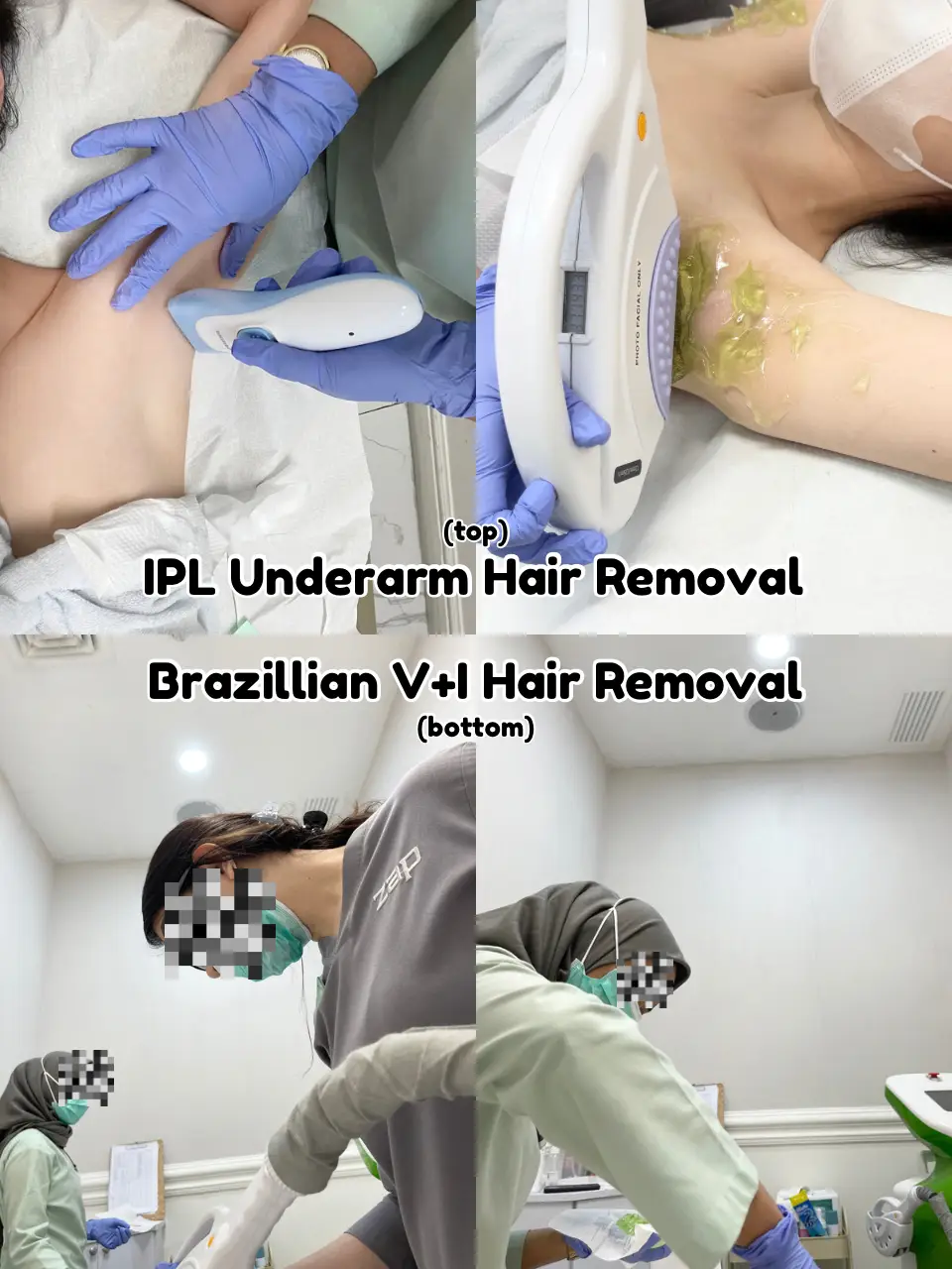 Brazilian hair removal outlet zap review