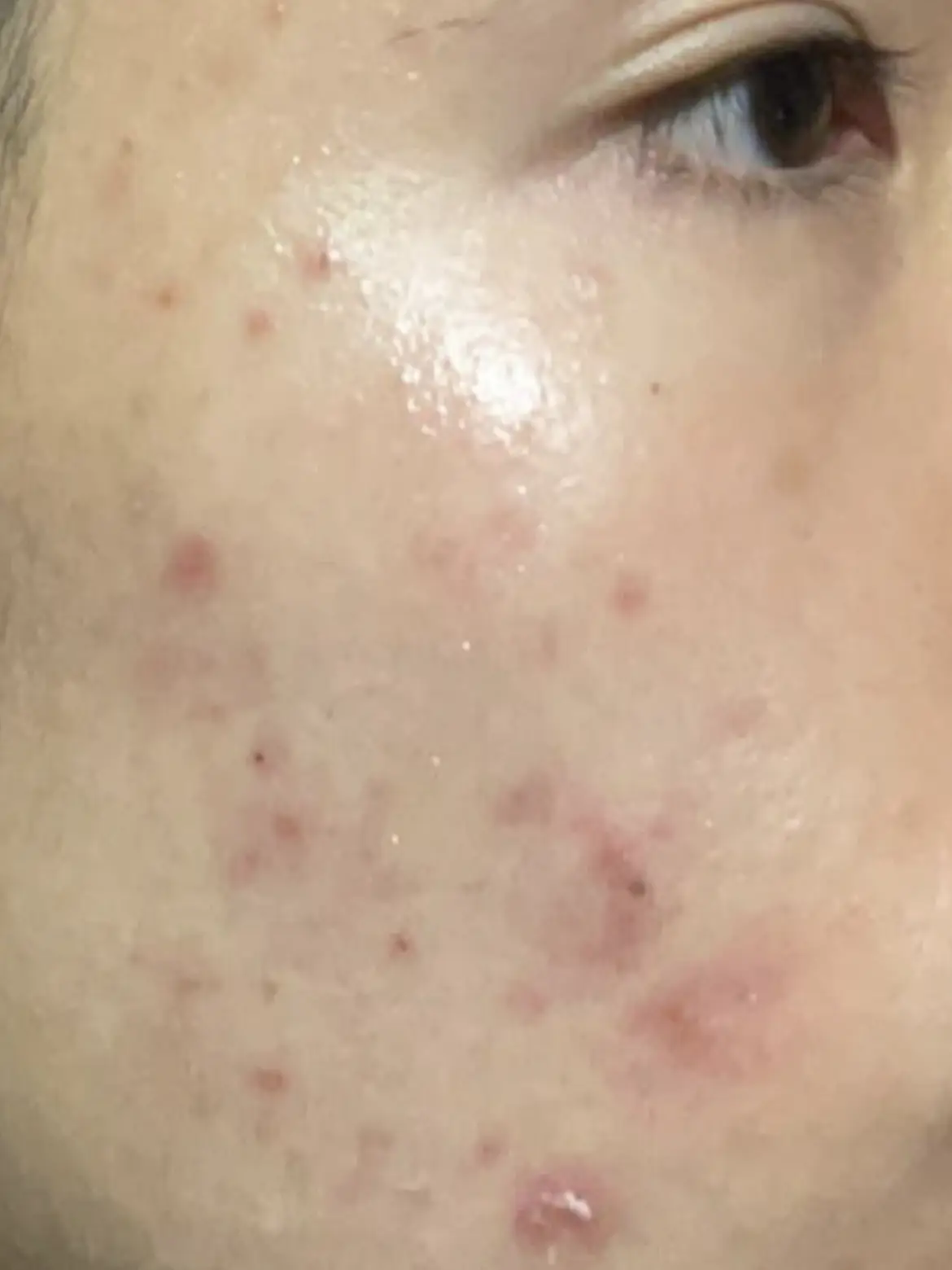 How I got rid of my acne's images(3)