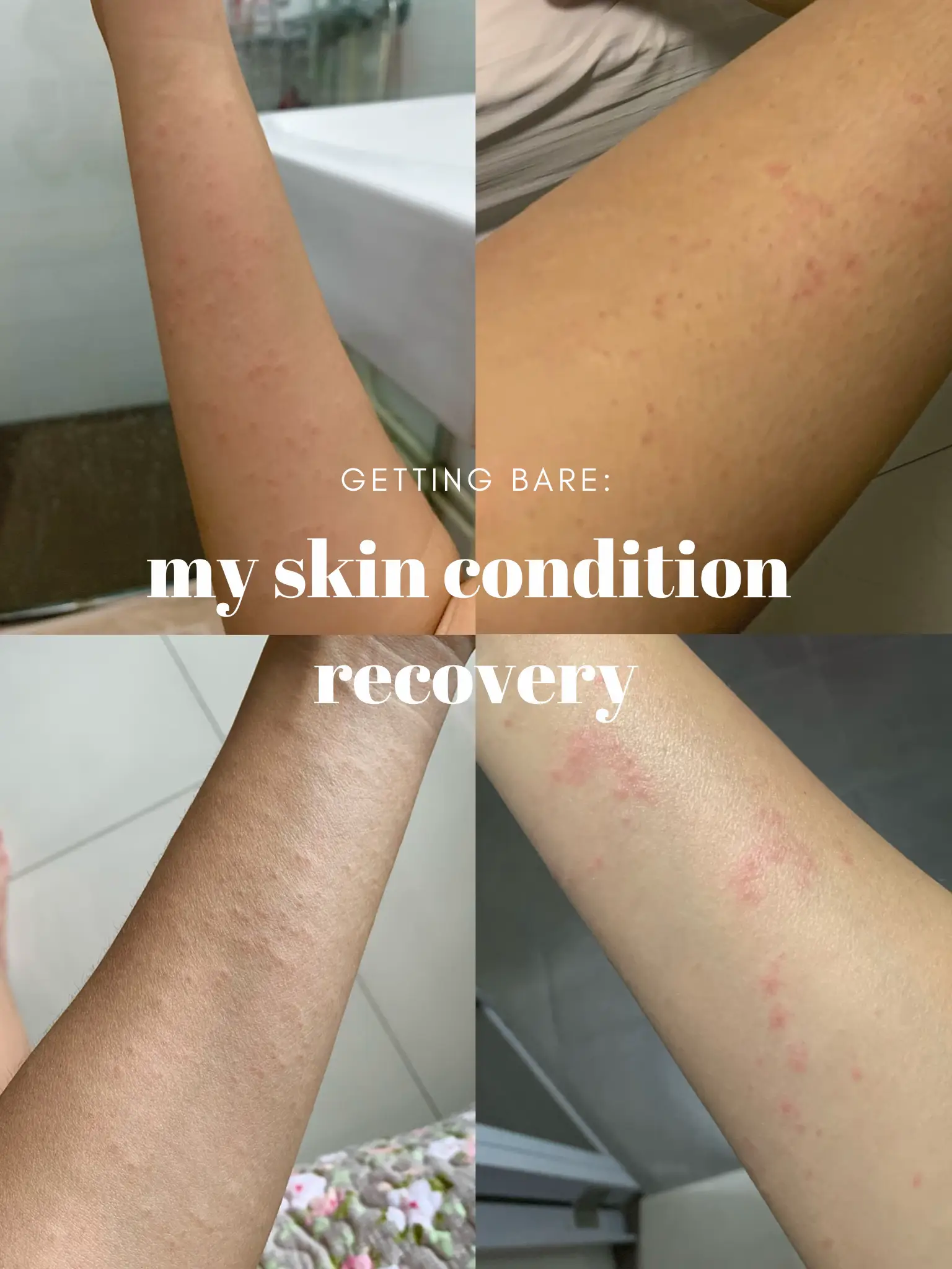 the product that helped my hives/ eczema journey 's images(0)