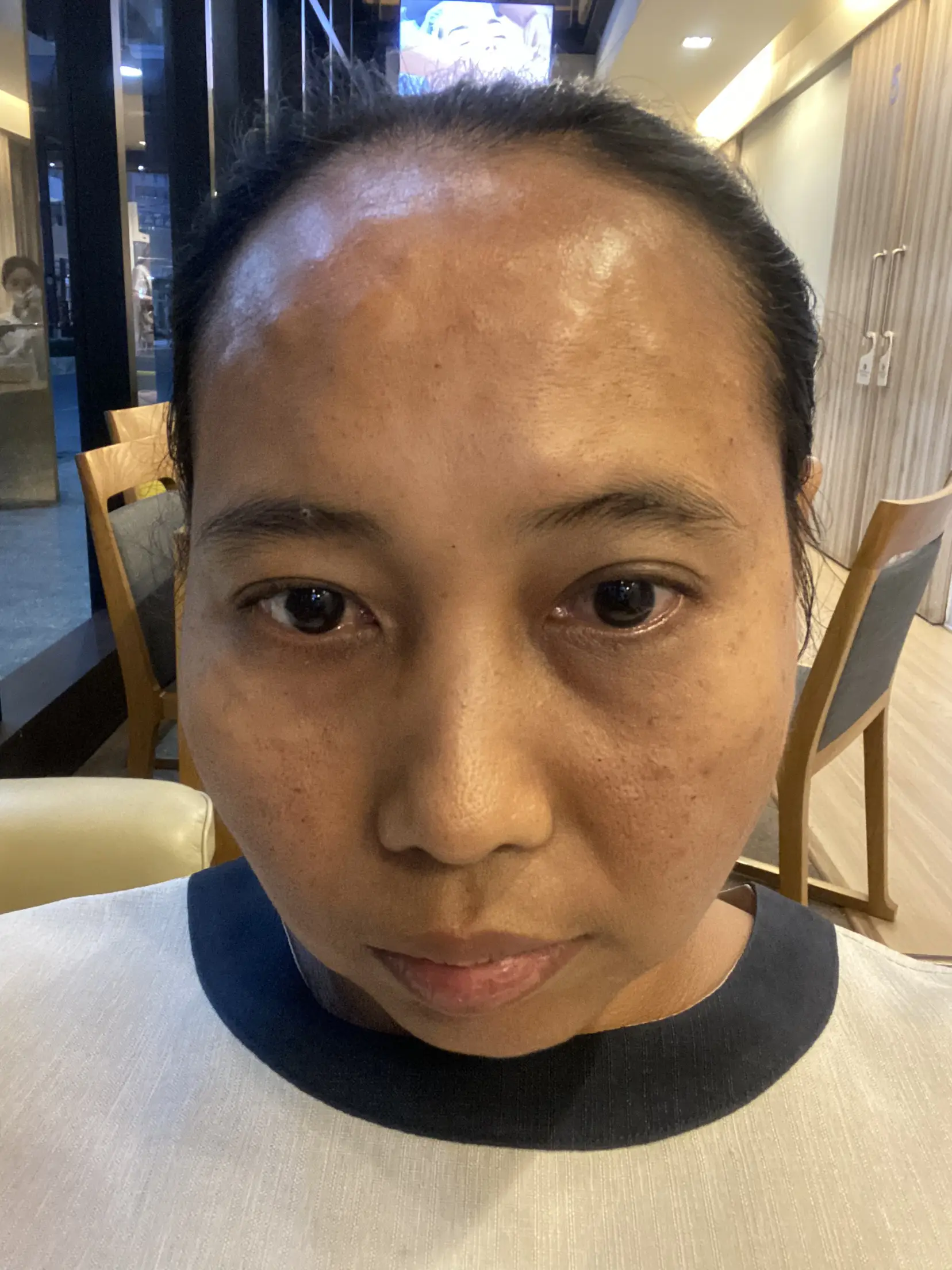 รีวิวฉีด rejuran & chanel ครบ 💉💉💉 ที่ skin club clinic แกลเลอรีที่