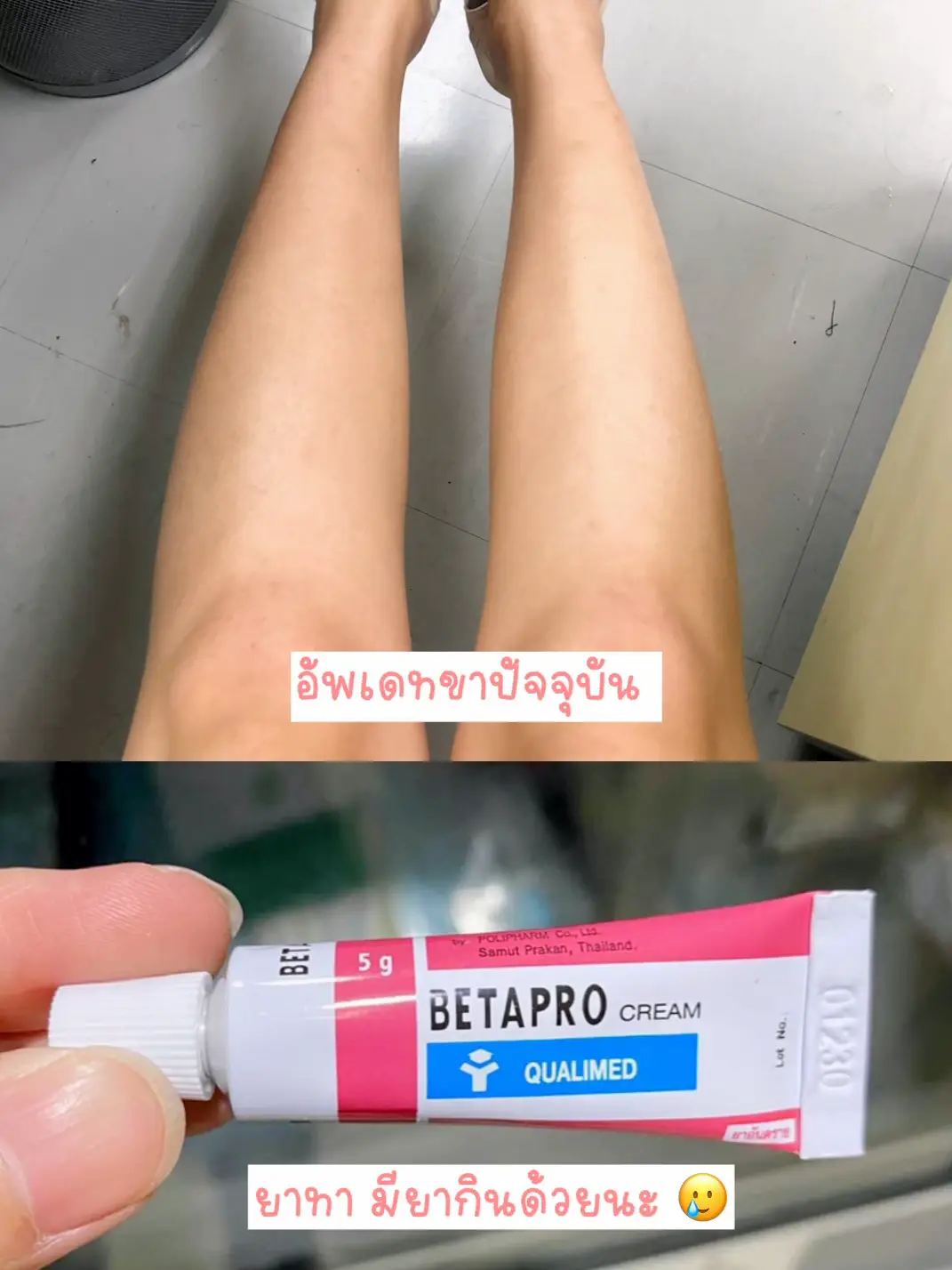 💥เลเซอร์รอยสิวครั้งแรก👀 รอยสิวหายแถมรูขุมขนกระชับ ⁉️เว่อเกิ๊นน | แกลเลอ ...