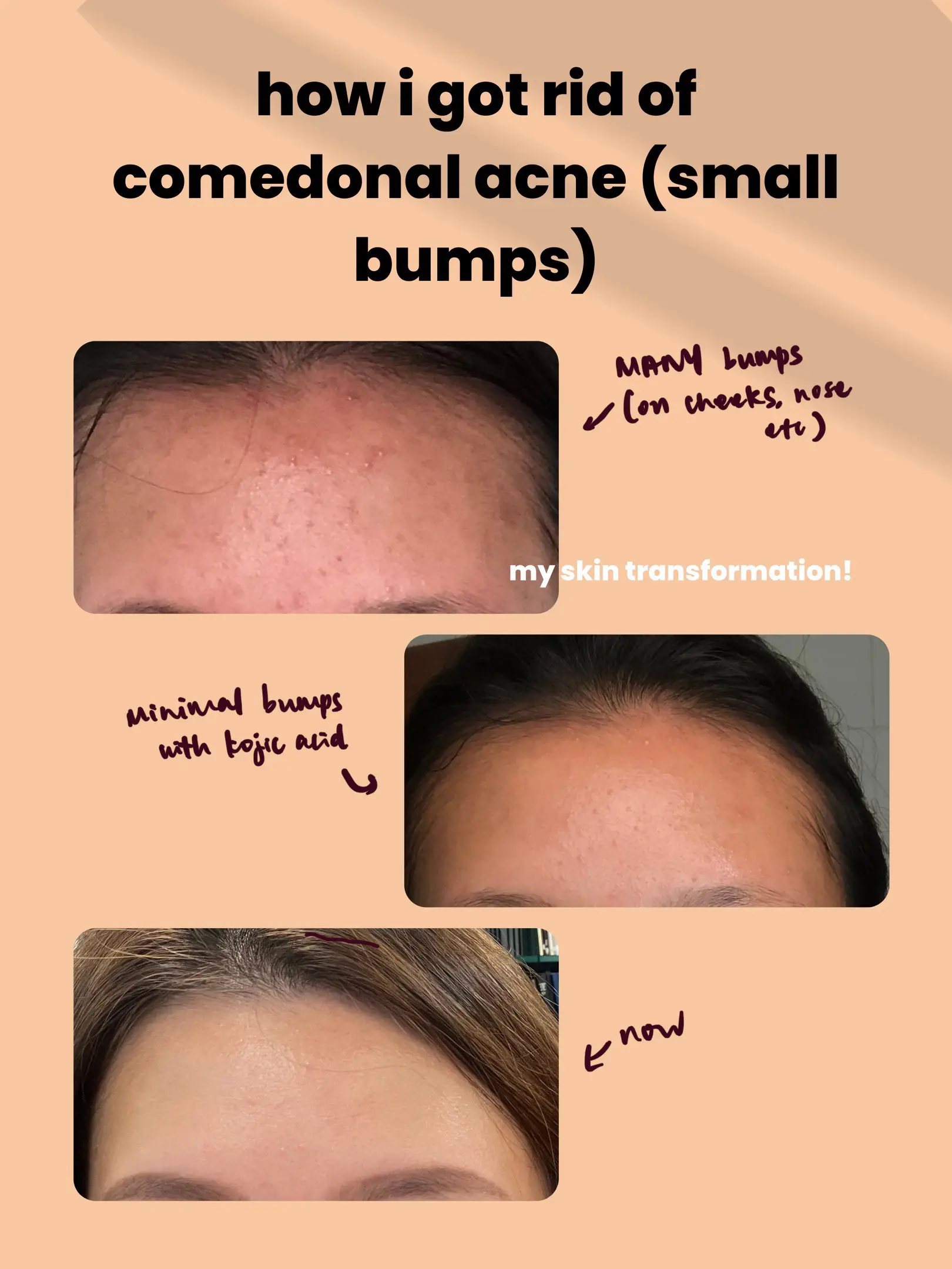 Using ACID SOAP for ACNE (my skincare journey)'s images(0)