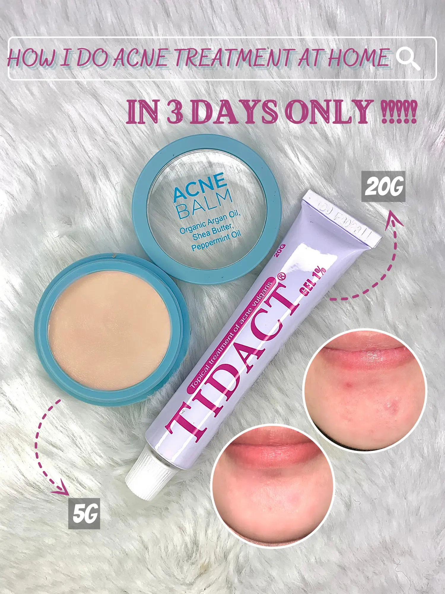 how i do acne treament at home Galeri disiarkan oleh Yasmin Aminin Lemon8