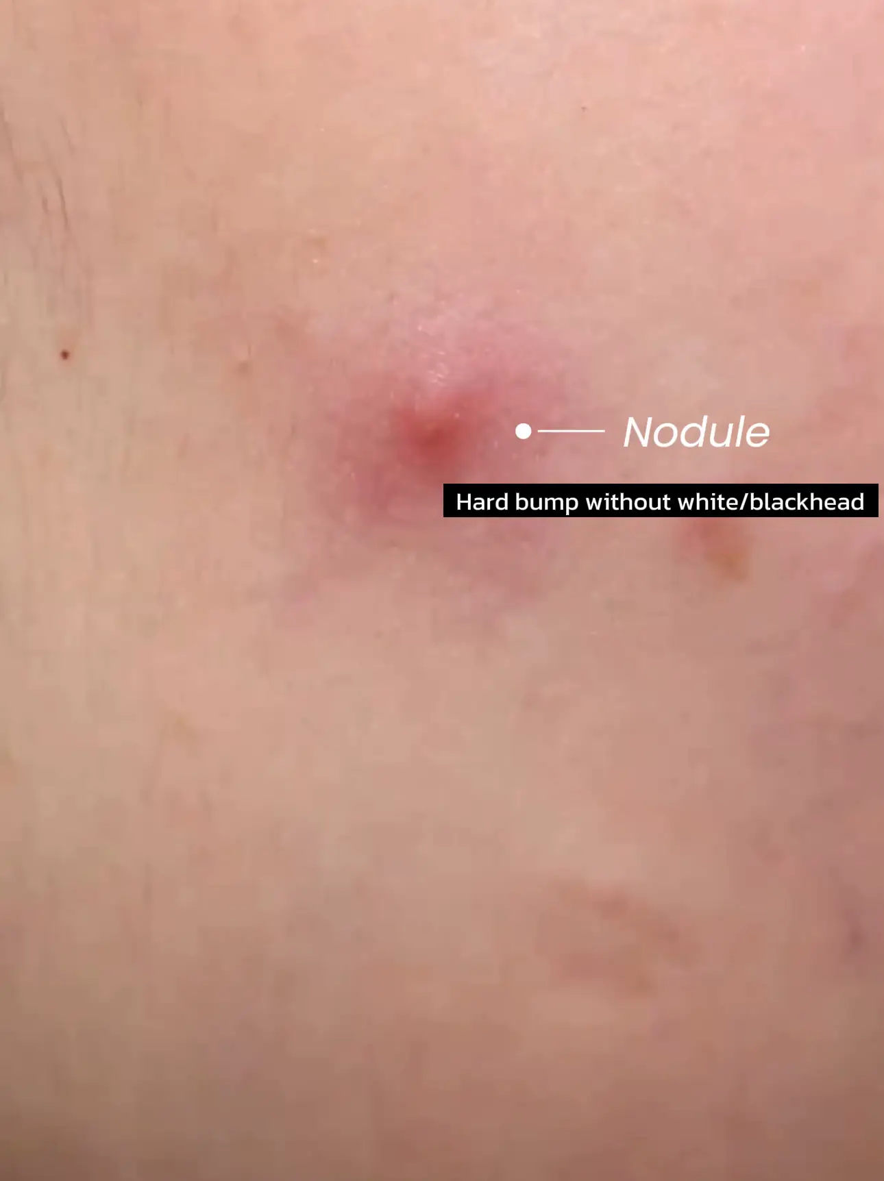Identifying acne that can be extracted's images(2)