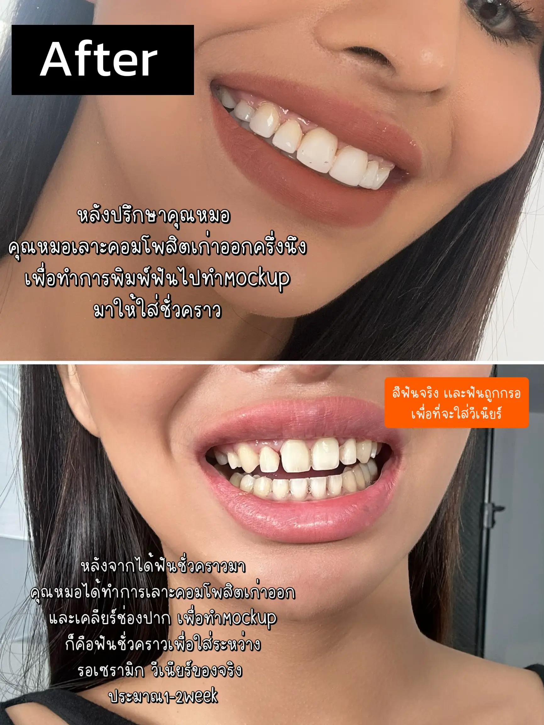 วีเนียร์ โรงพยาบาลรัฐ ราคา - การค้นหาใน Lemon8