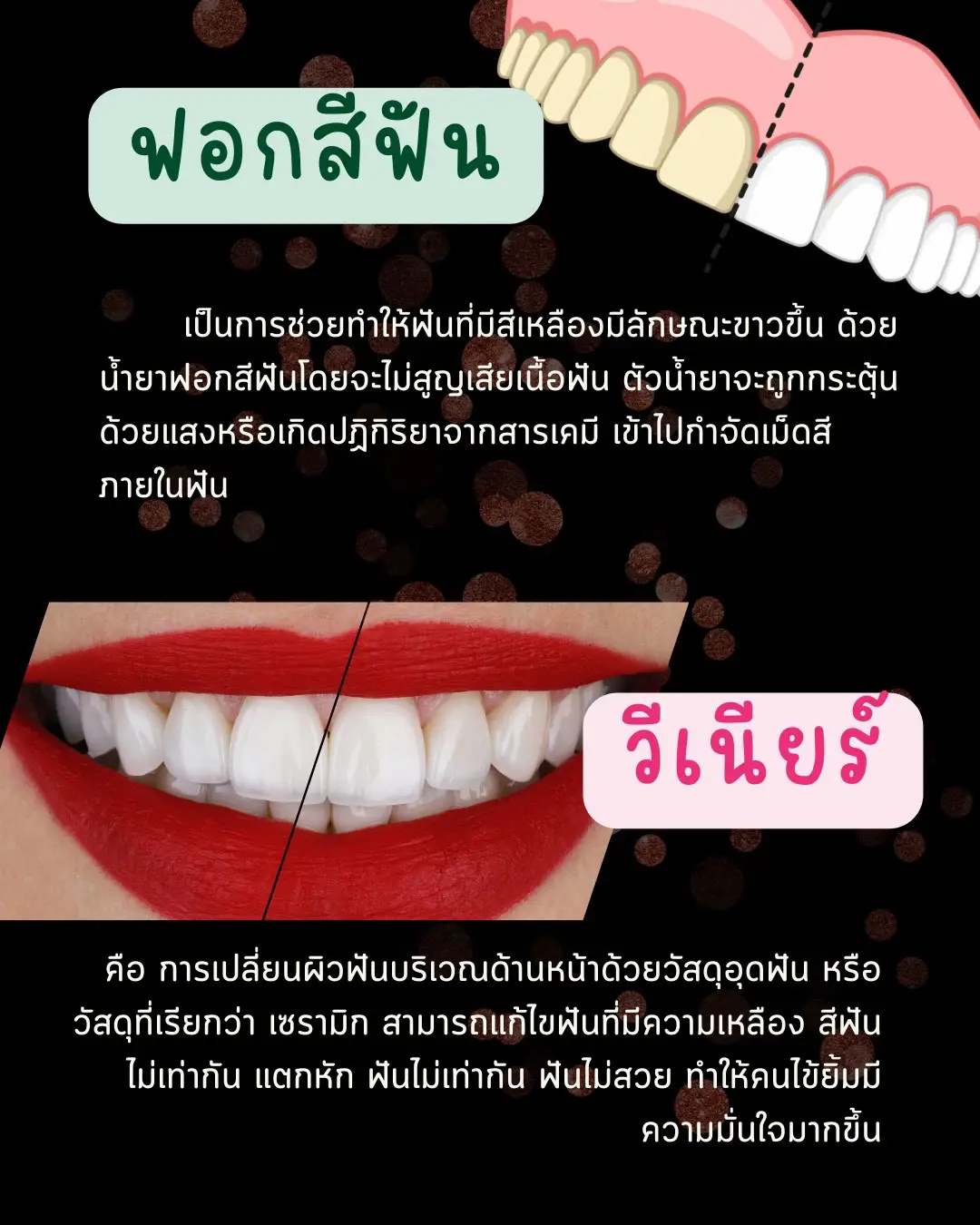 ฟอกสีฟันและวีเนียร์ ต่างกันอย่างไร | แกลเลอรีที่โพสต์โดย กอล์ฟห้องฟัน ...