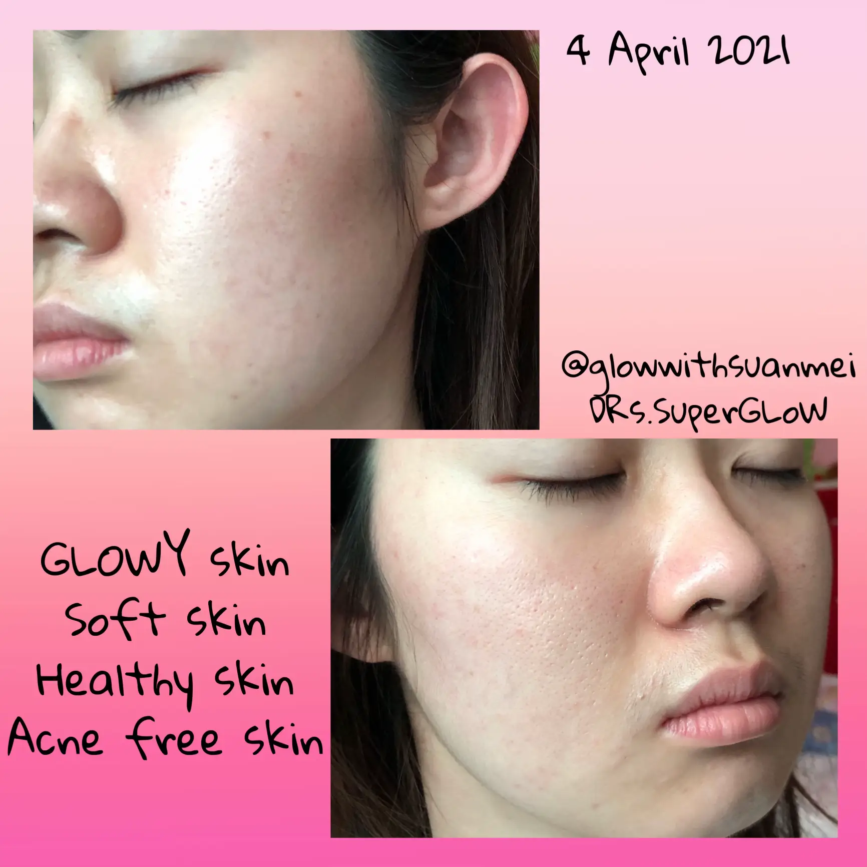 A skincare that I stick with 3 years! acne & clogs's images(7)