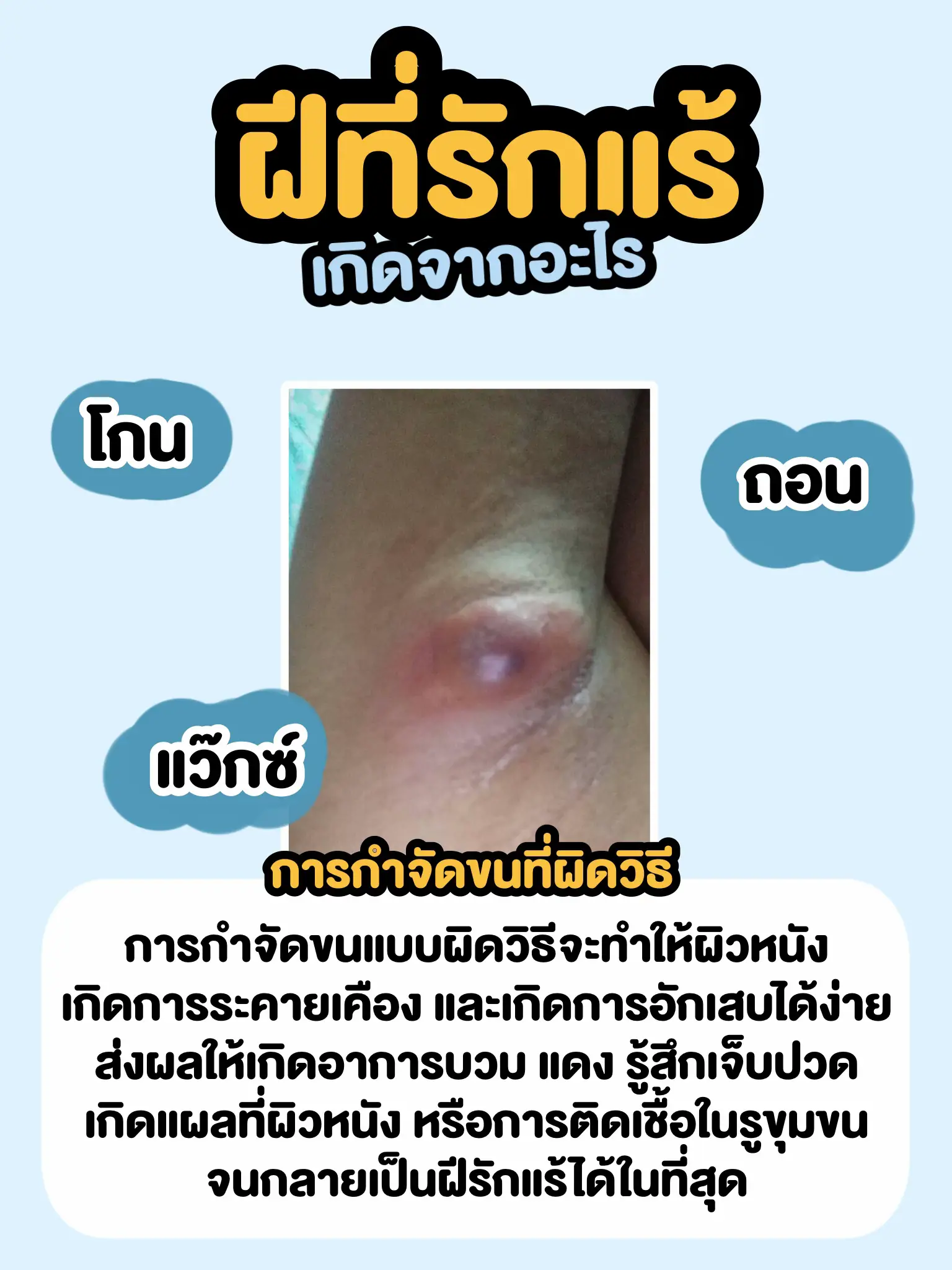 รู้หรือไม่?! ฝีที่รักแร้เกิดจากอะไร | แกลเลอรีที่โพสต์โดย Labx clinic ...