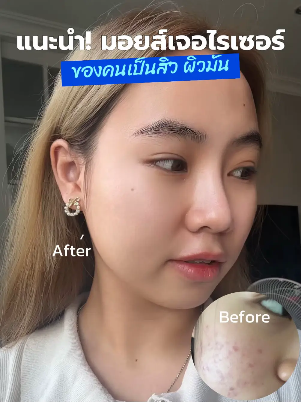  ️เจอแล้ว ️ มอยเจอไรเซอร์ สำหรับคนเป็นสิว ผิวมัน😭 