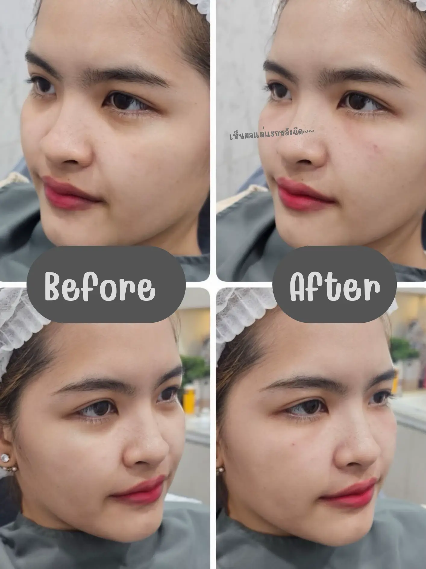 ฉีด Filler ใต้ตาที่ Emma | แกลเลอรีที่โพสต์โดย imnueathong | Lemon8