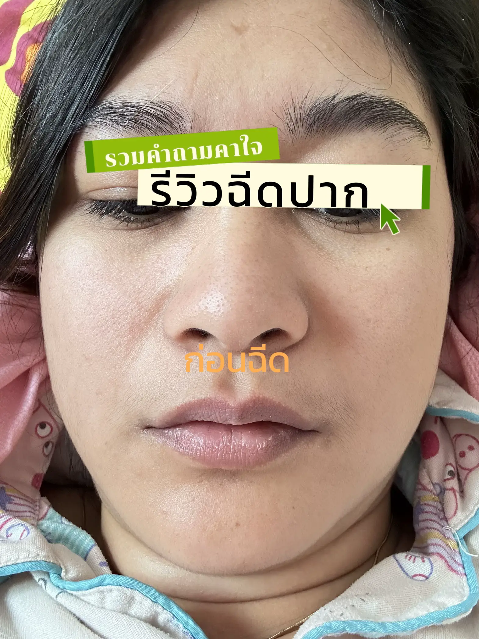 รีวิวฉีดปากครั้งแรกหทัยทิพย์คลีนิค💉💉💉 | แกลเลอรีที่โพสต์โดย Jariya ...