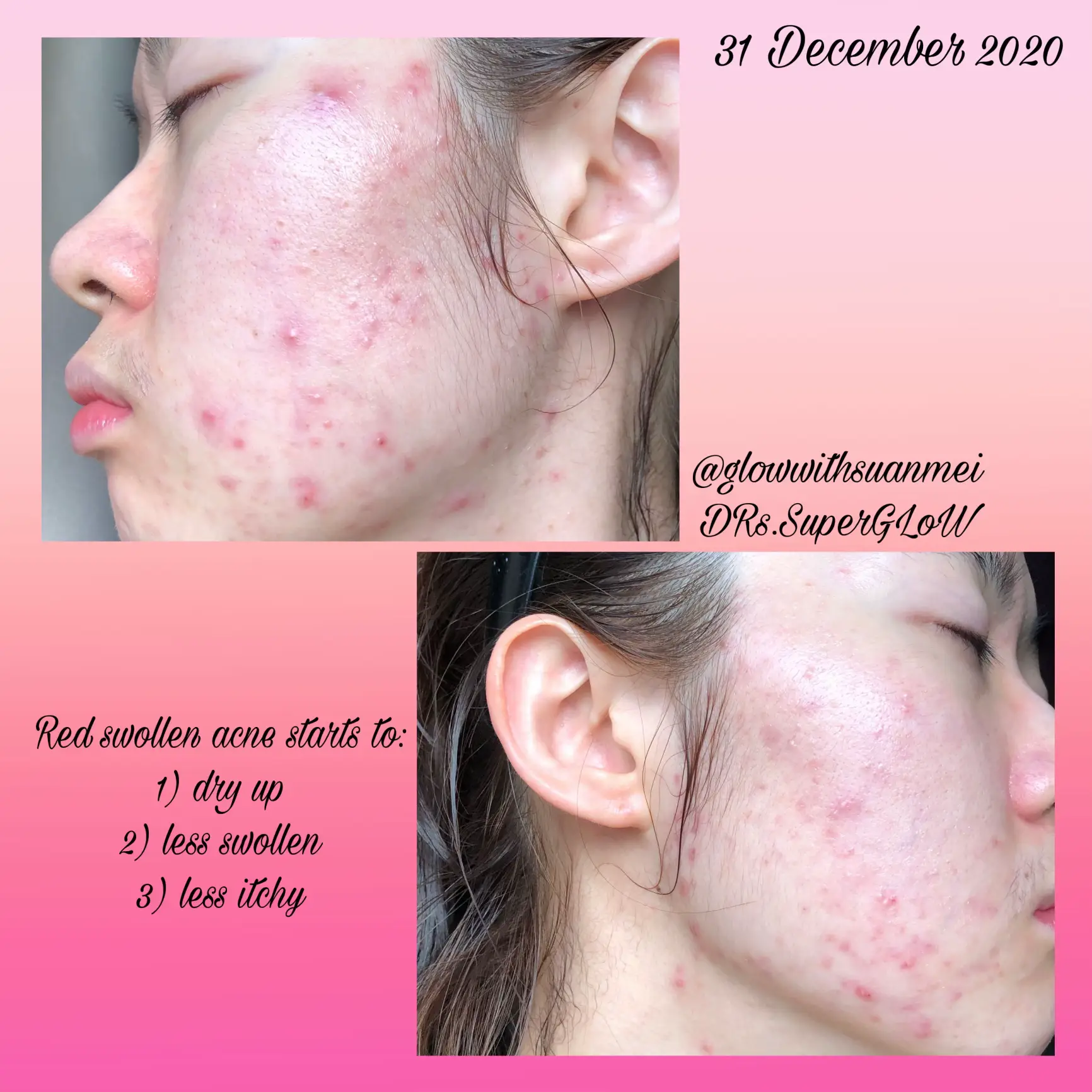 A skincare that I stick with 3 years! acne & clogs's images(2)