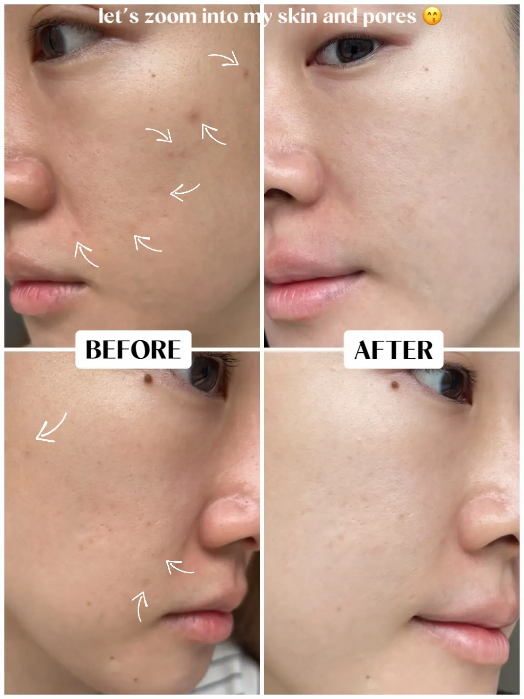 Pico Laser after 2 wks⚡️ Let’s talk skin treatments's images(8)