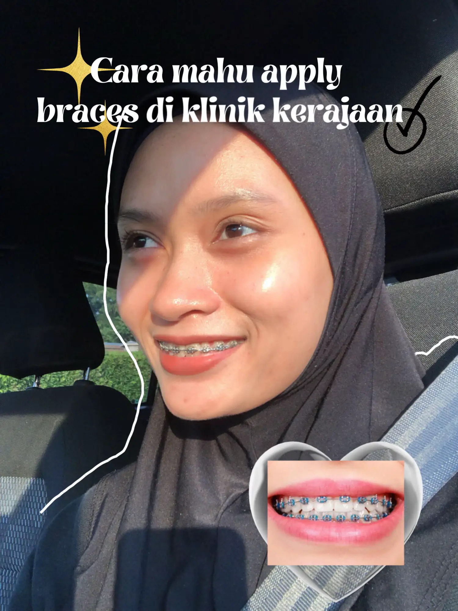 Cara apply braces di klinik kerajaan Galeri disiarkan oleh Yini Lemon8