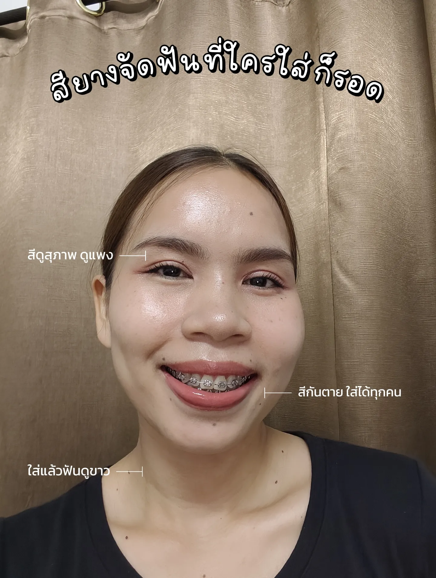 สียางจัดฟันที่ใส่แล้วปังงงง 🦷 | แกลเลอรีที่โพสต์โดย Petch p.th.n | Lemon8