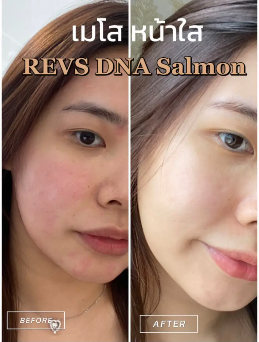 รีวิวทำ เมโสหน้าใส Revs ช่วยกระชับรูขุมขน ผิวเด้งอิ่มฟู ✨ |  แกลเลอรีที่โพสต์โดย Giffin_G | Lemon8