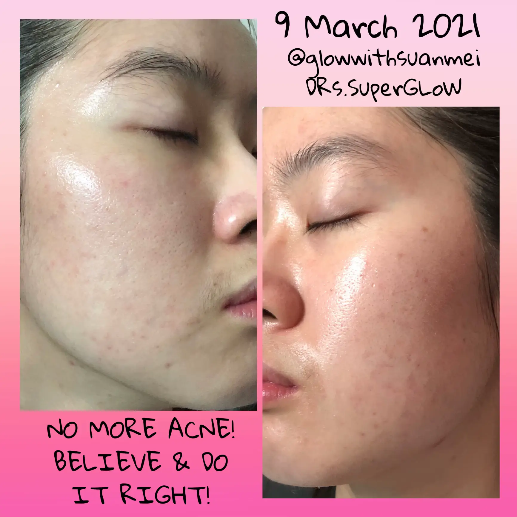 A skincare that I stick with 3 years! acne & clogs's images(6)