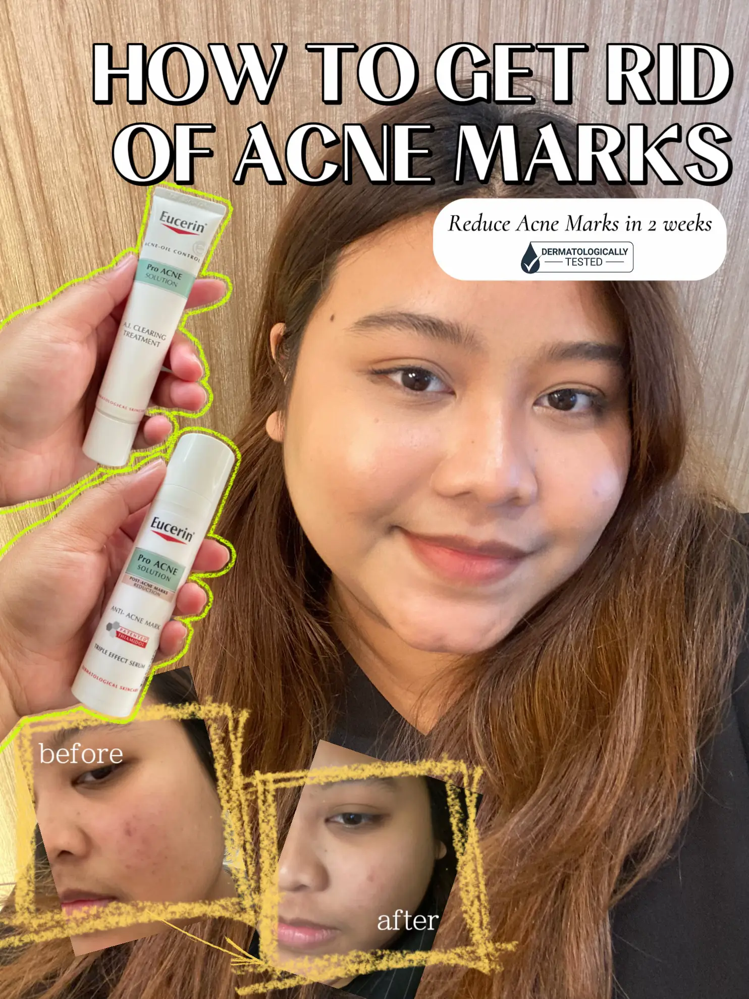 how-to-get-rid-of-acne-marks-eucerin-products-galeri-disiarkan-oleh