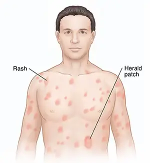 Rash under breast : r/DiagnoseMe