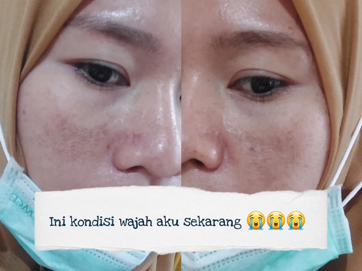 Pejuang Flek hitam di wajah | Galeri diposting oleh Novila sari | Lemon8