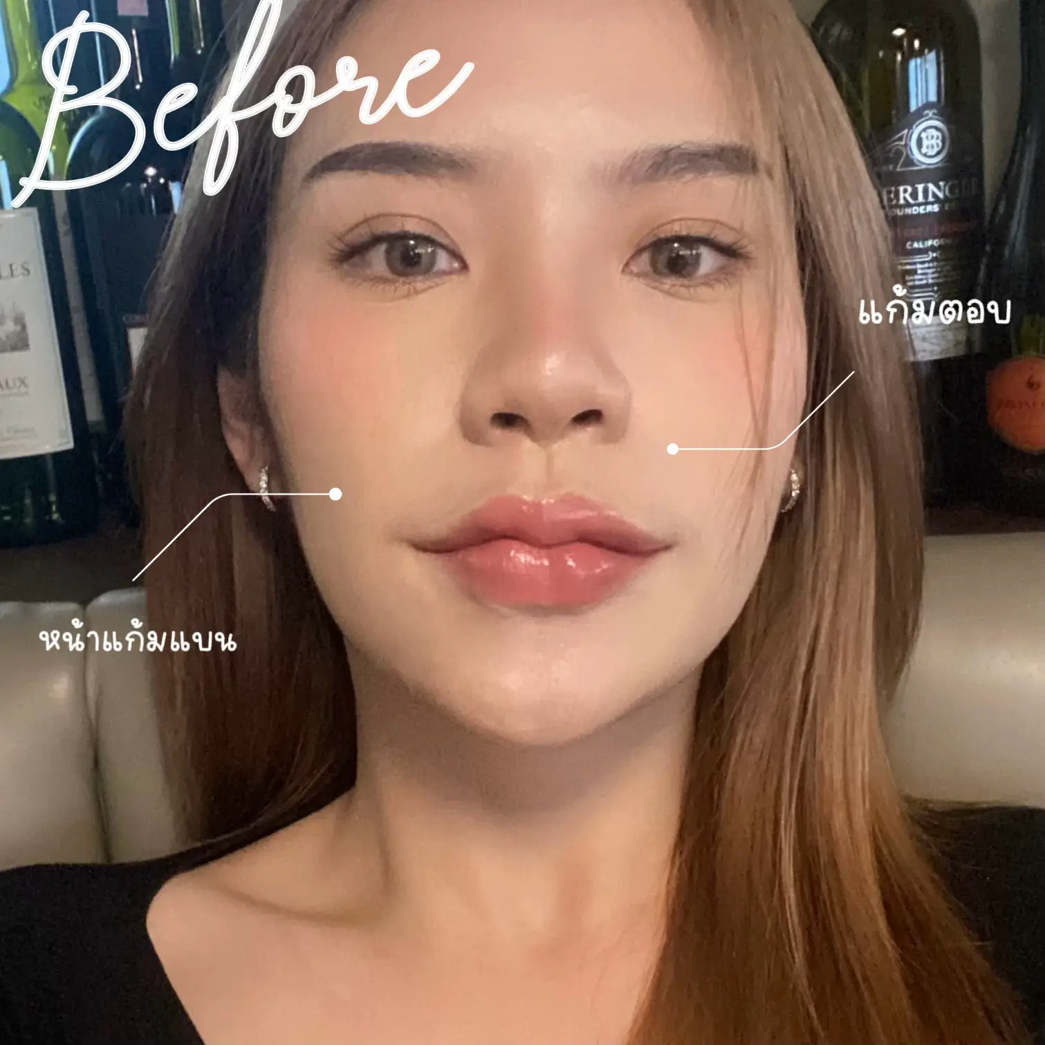 บอกลาหน้าแก่ก่อนวัย เพียงแค่ฉีดฟิลเลอร์ 🥰 | แกลเลอรีที่โพสต์โดย Eyertw🌷