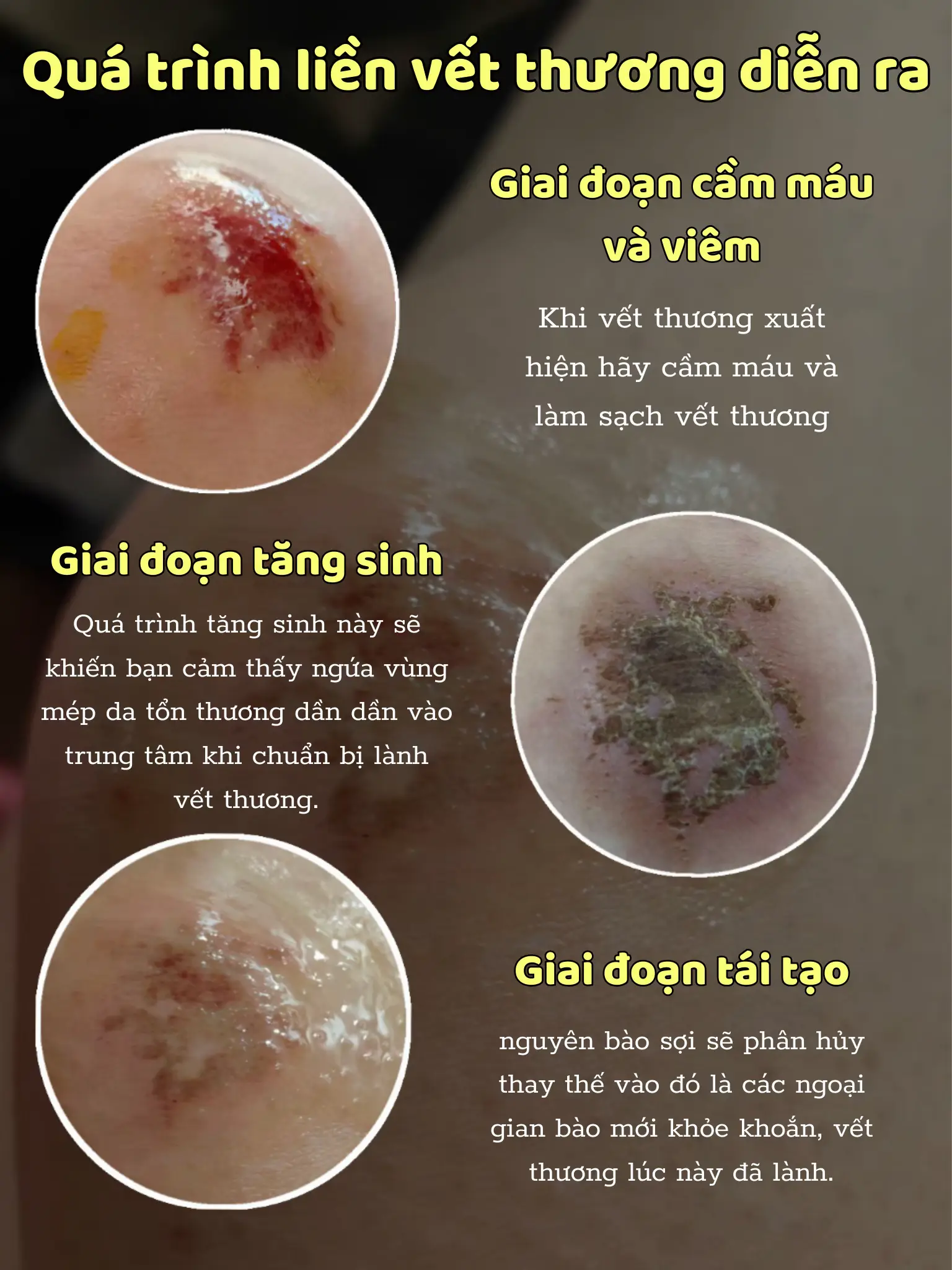 LƯU Ý QUÁ TRÌNH LIỀN VẾT THƯƠNG NHANH VÀ ÍT SẸO | Bộ sưu tập do Bảo Bối ...