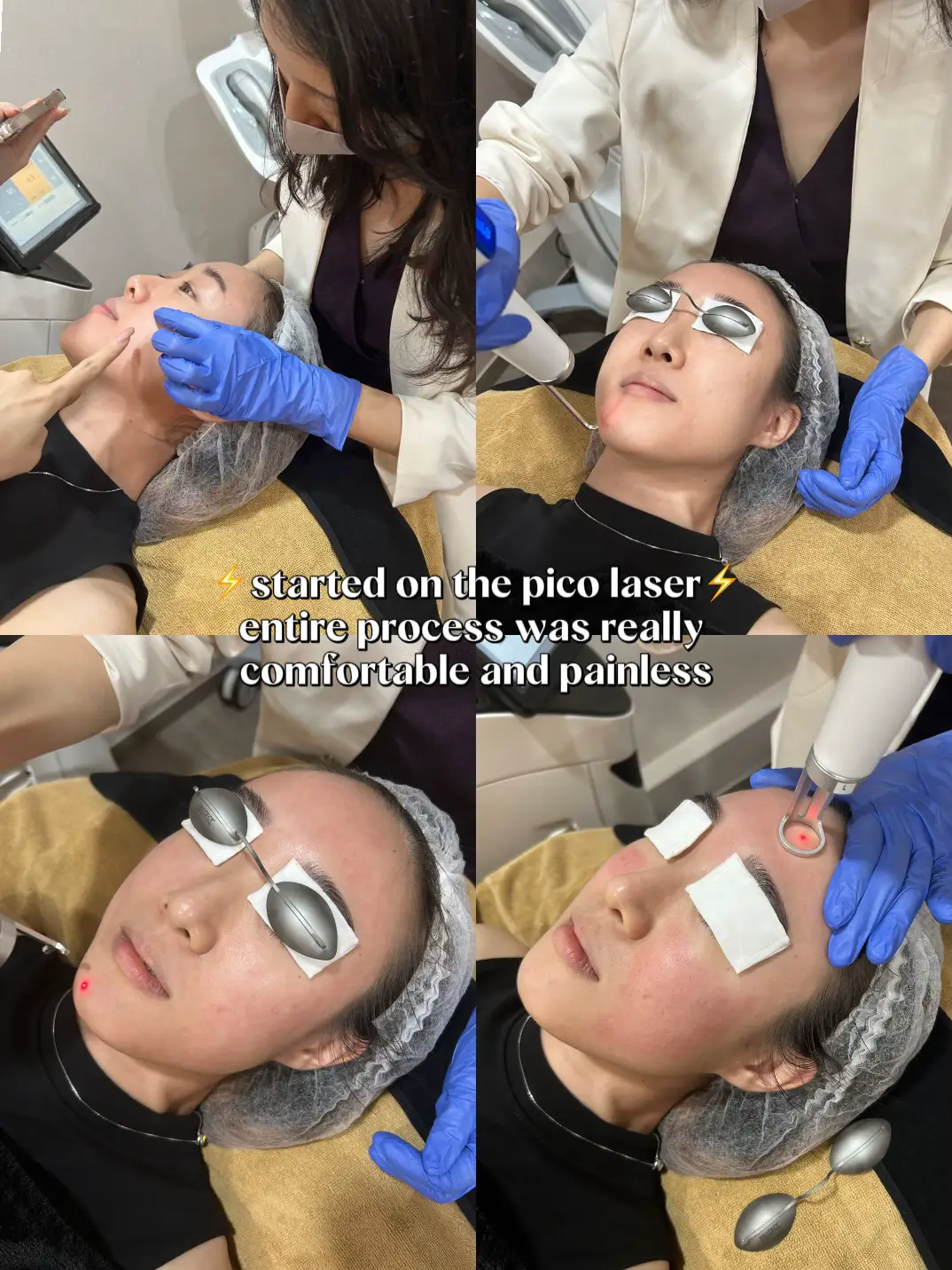 Pico Laser after 2 wks⚡️ Let’s talk skin treatments's images(4)