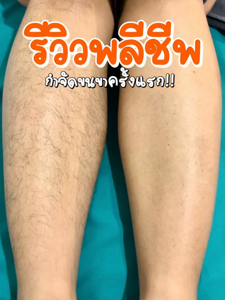 First Leg Hair Removal Review 🥹 Gallery posted by MoFo Lemon8