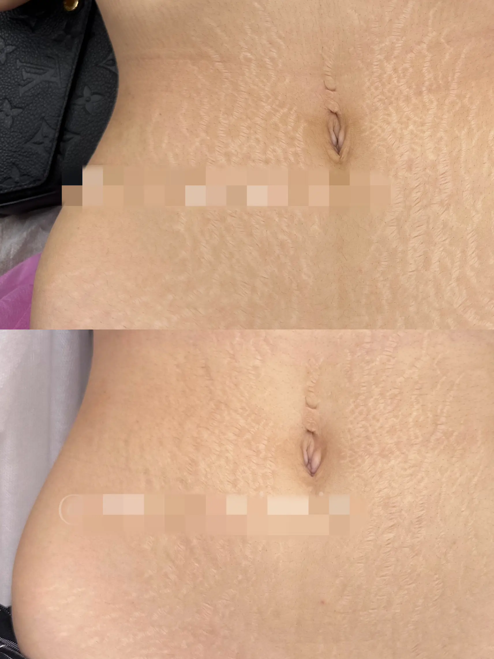 New Beauty Body No Stretch Marks & No Asymmetry & Arepermanent