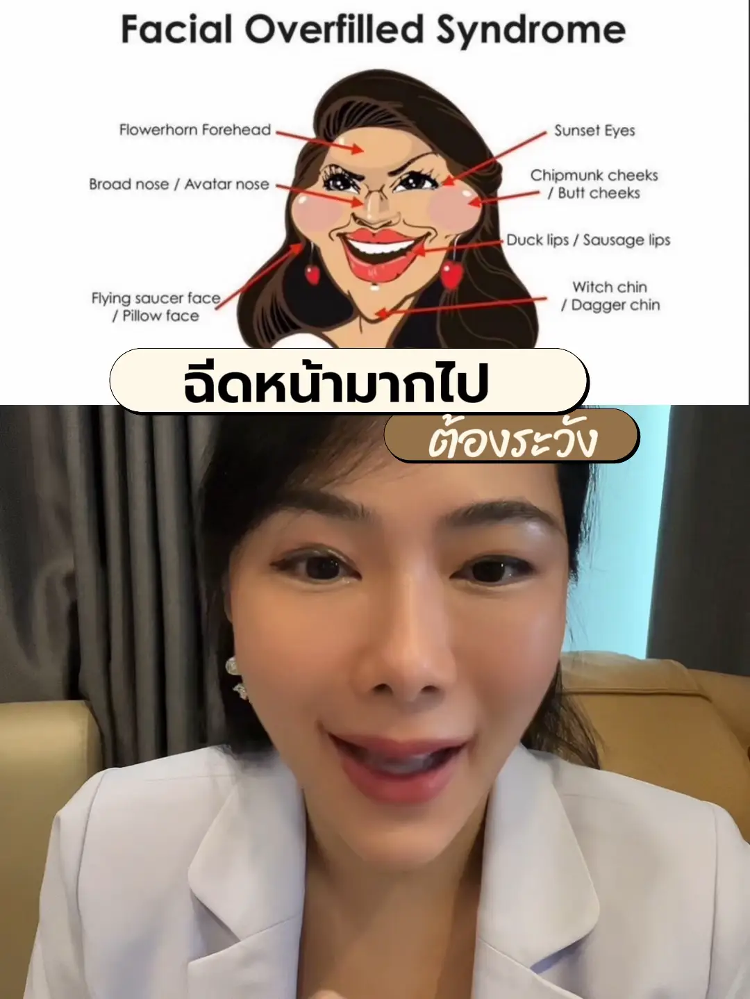 ฉีดหน้ามากไป จะเป็นแบบนี้ Facial overfilled syndrome | วิดีโอที่เผยแพร่ ...