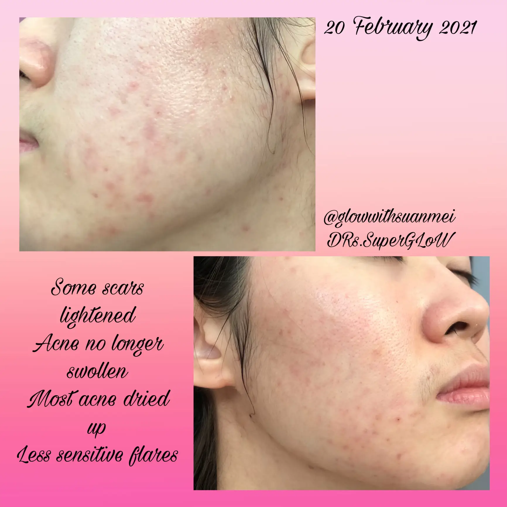 A skincare that I stick with 3 years! acne & clogs's images(5)