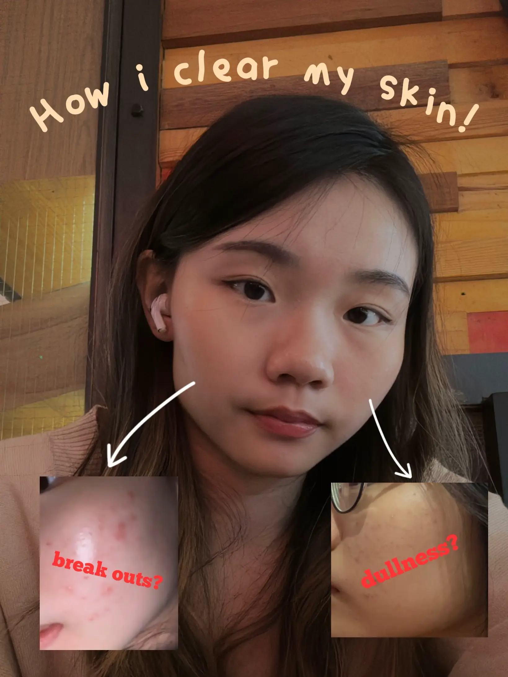 My acne journey🧖‍♀️'s images(0)