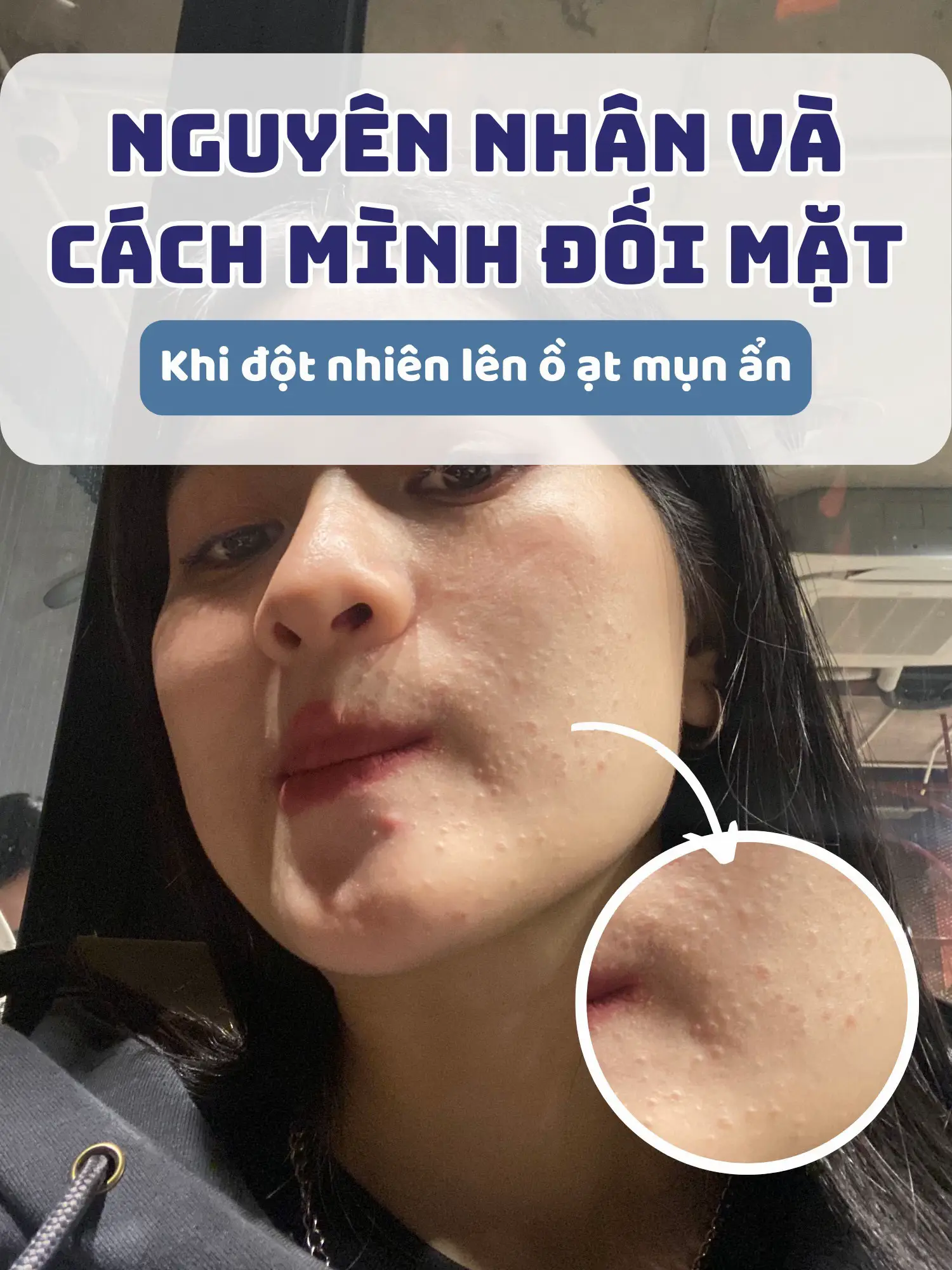 5. Các Lưu Ý Quan Trọng Khi Xử Lý Mụn Ẩn