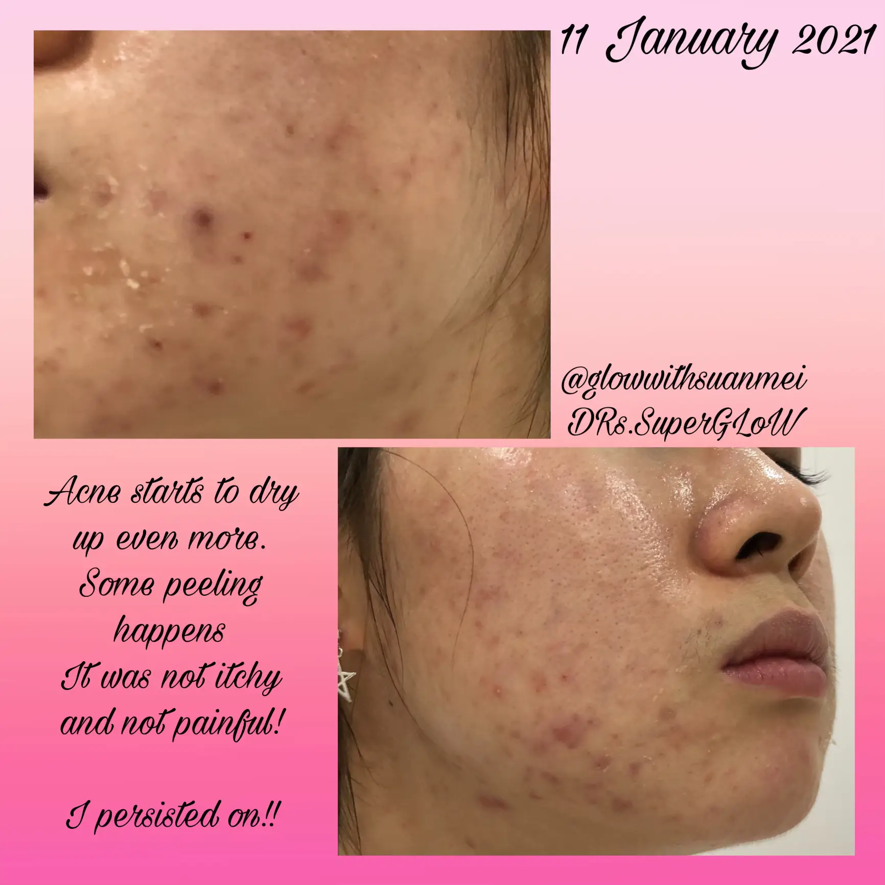 A skincare that I stick with 3 years! acne & clogs's images(3)