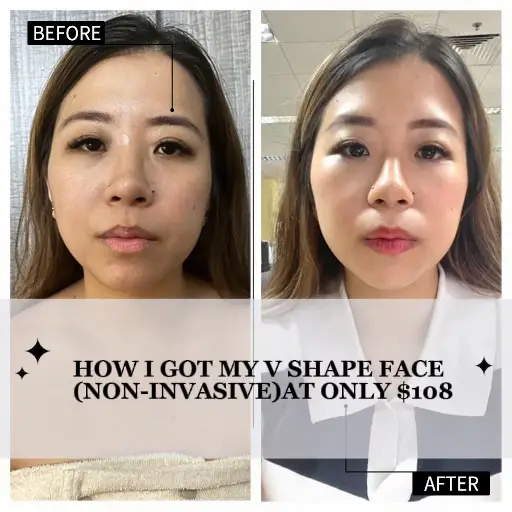 Achieved my V shape face without surgery at $108! 's images(0)
