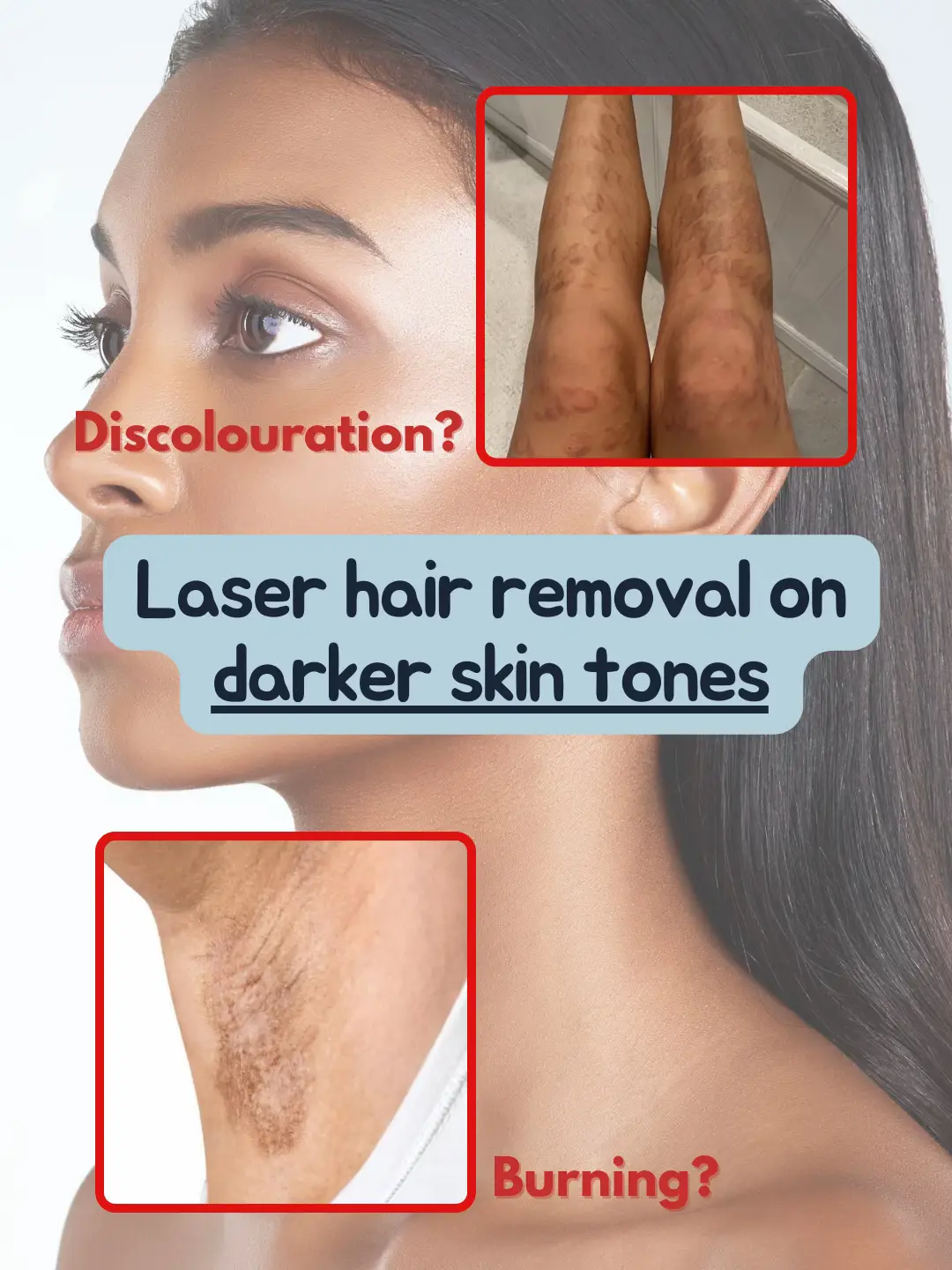 Laser Hair Removal on dark skin tones