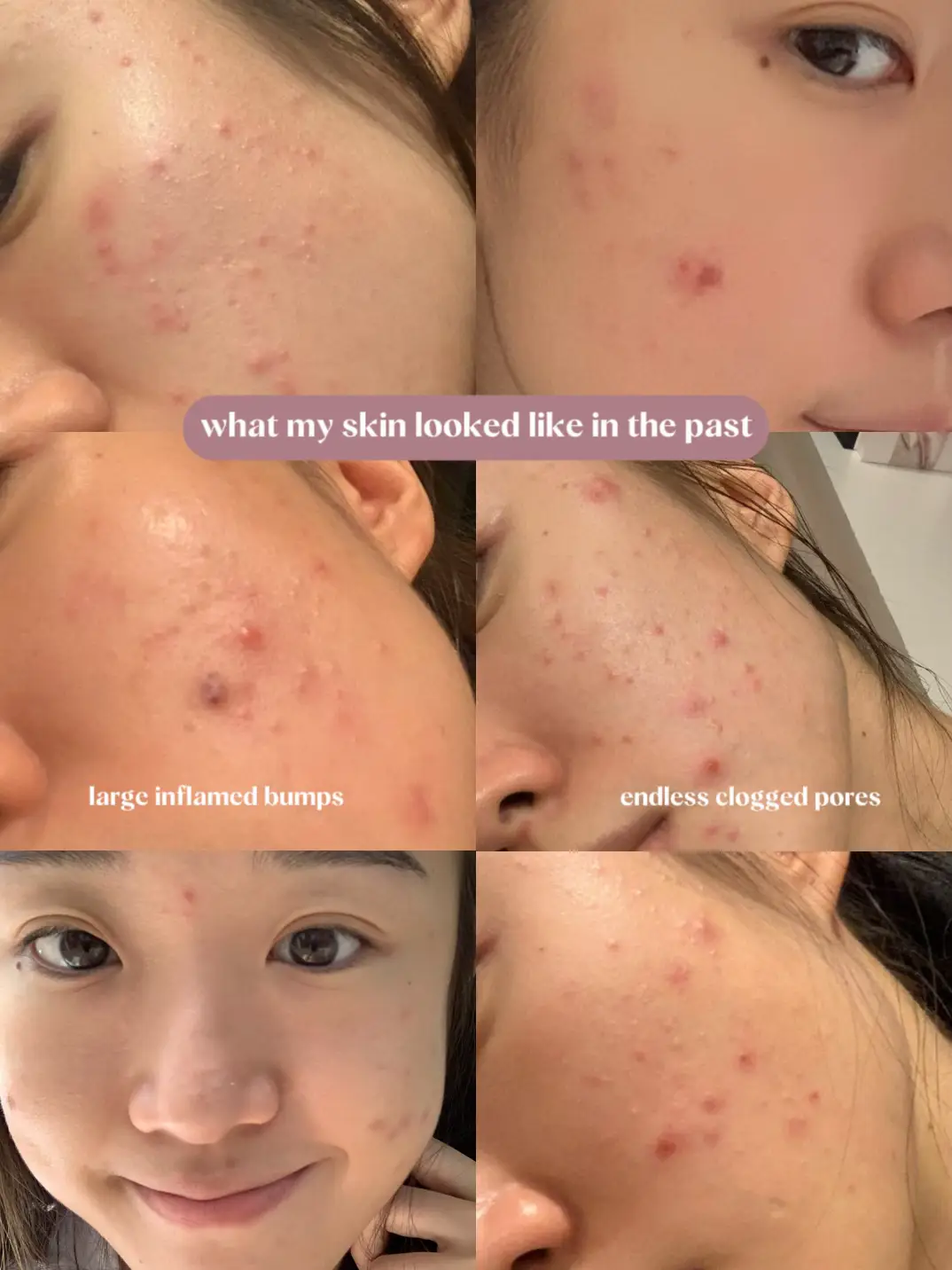 Acne tips and products that changed my life 😭's images(1)