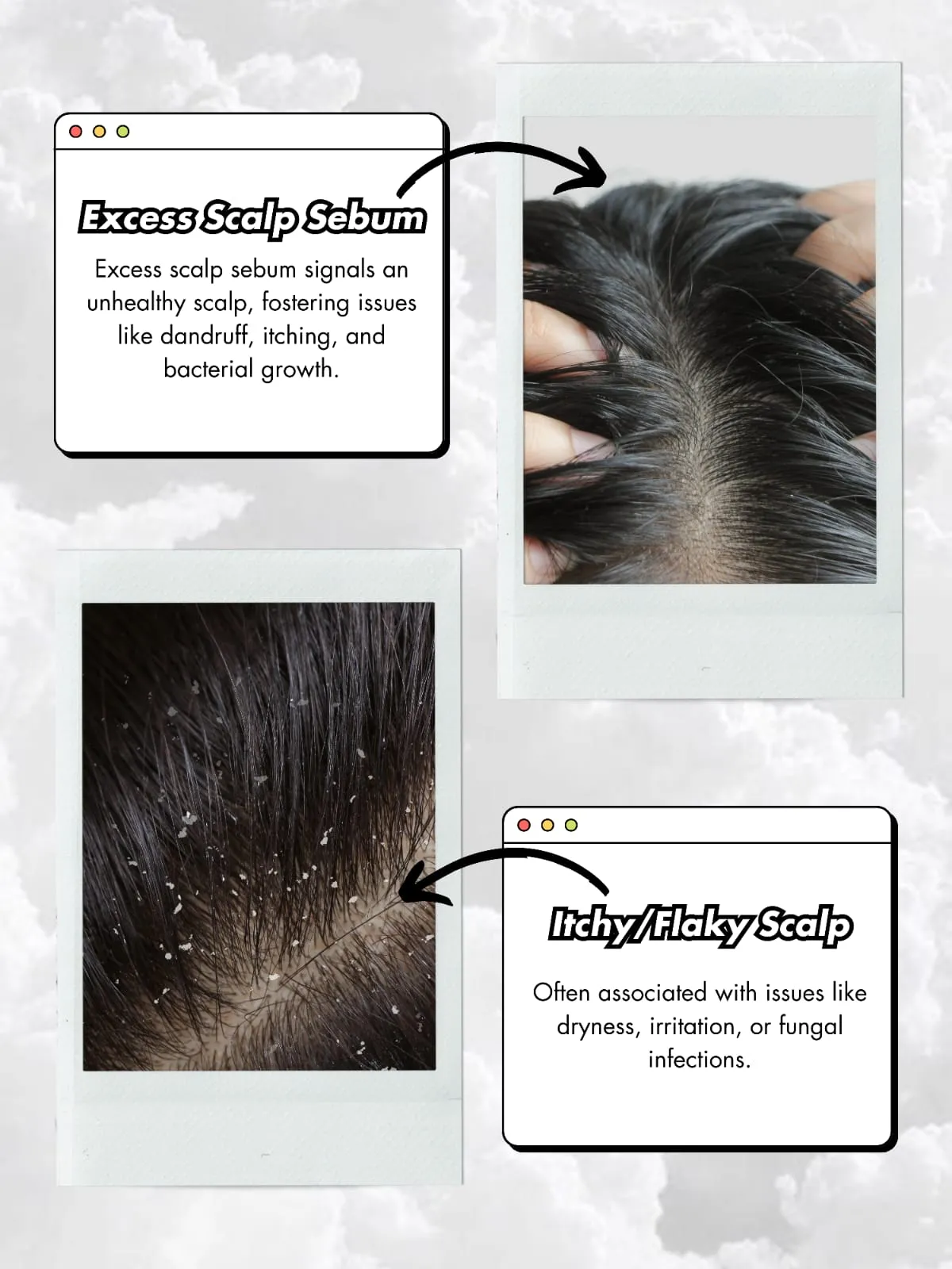 Excess Sebum on the Scalp: Causes & How to Remove It