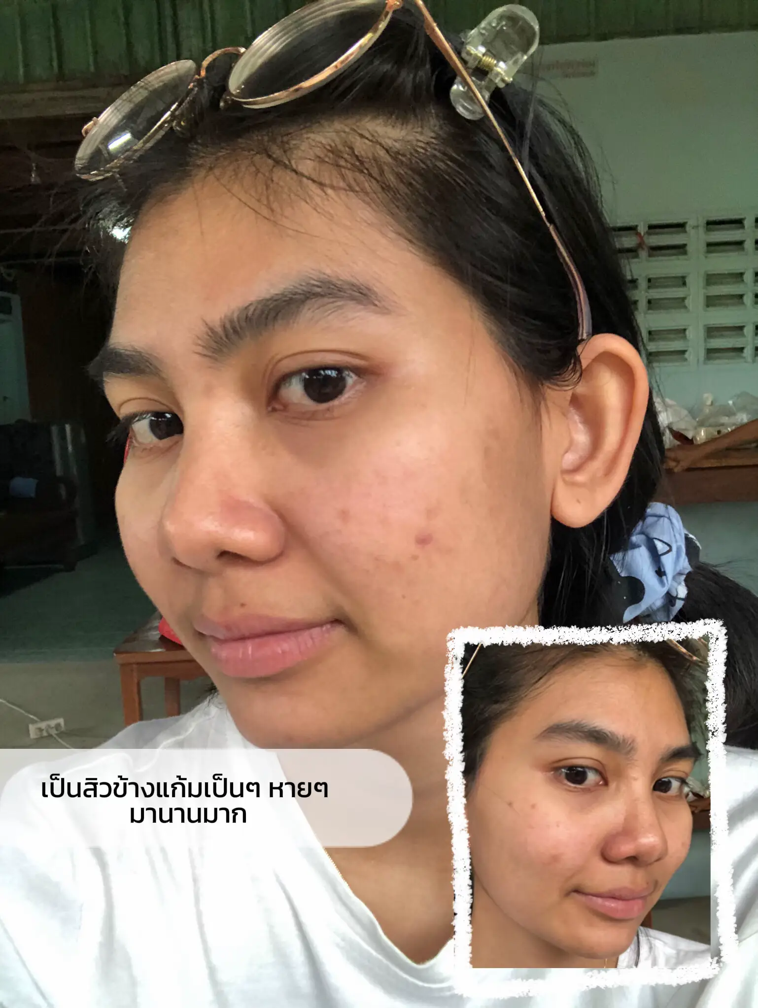 who-has-acne-marks-like-us-come-this-way-gallery-posted-by