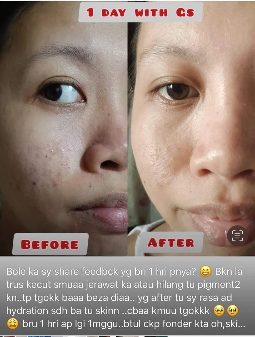 1 DAY ONLY RESULT GENUINE SKINCARE!!! | Gallery posted by ChristineFaizal |  Lemon8