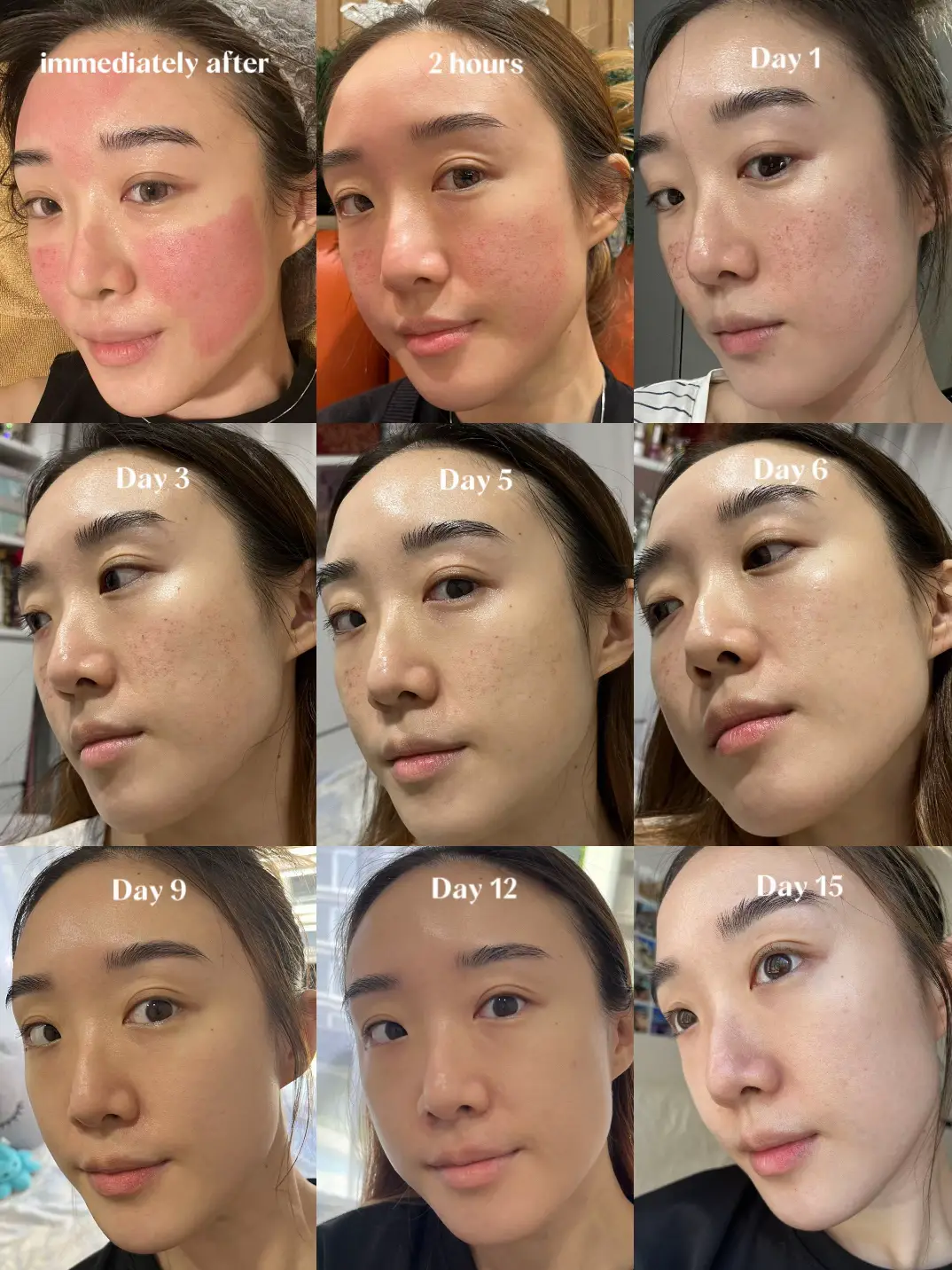 Pico Laser after 2 wks⚡️ Let’s talk skin treatments | Gallery posted by ...