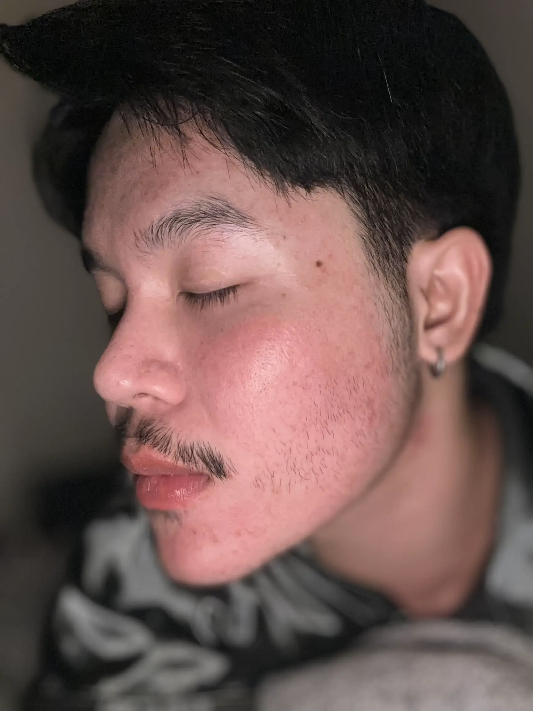 just-2-months-acne-disappeared-gallery-posted-by-lemon8