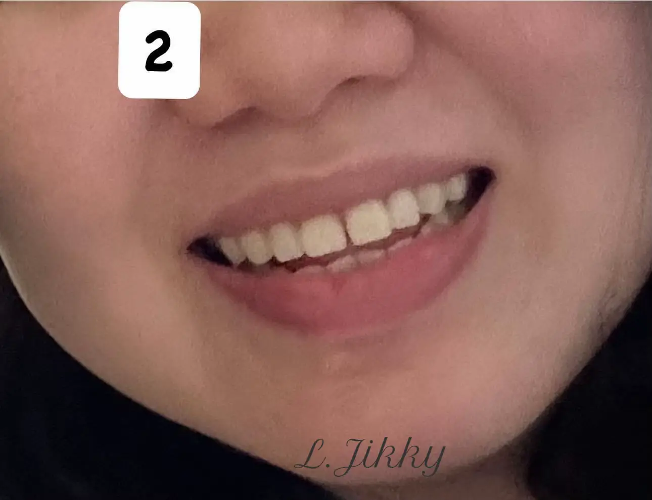 รีวิว 1ปี กับการจัดฟันดามอนในวัย 37ปี 😬 Damon Braces แกลเลอรีที่