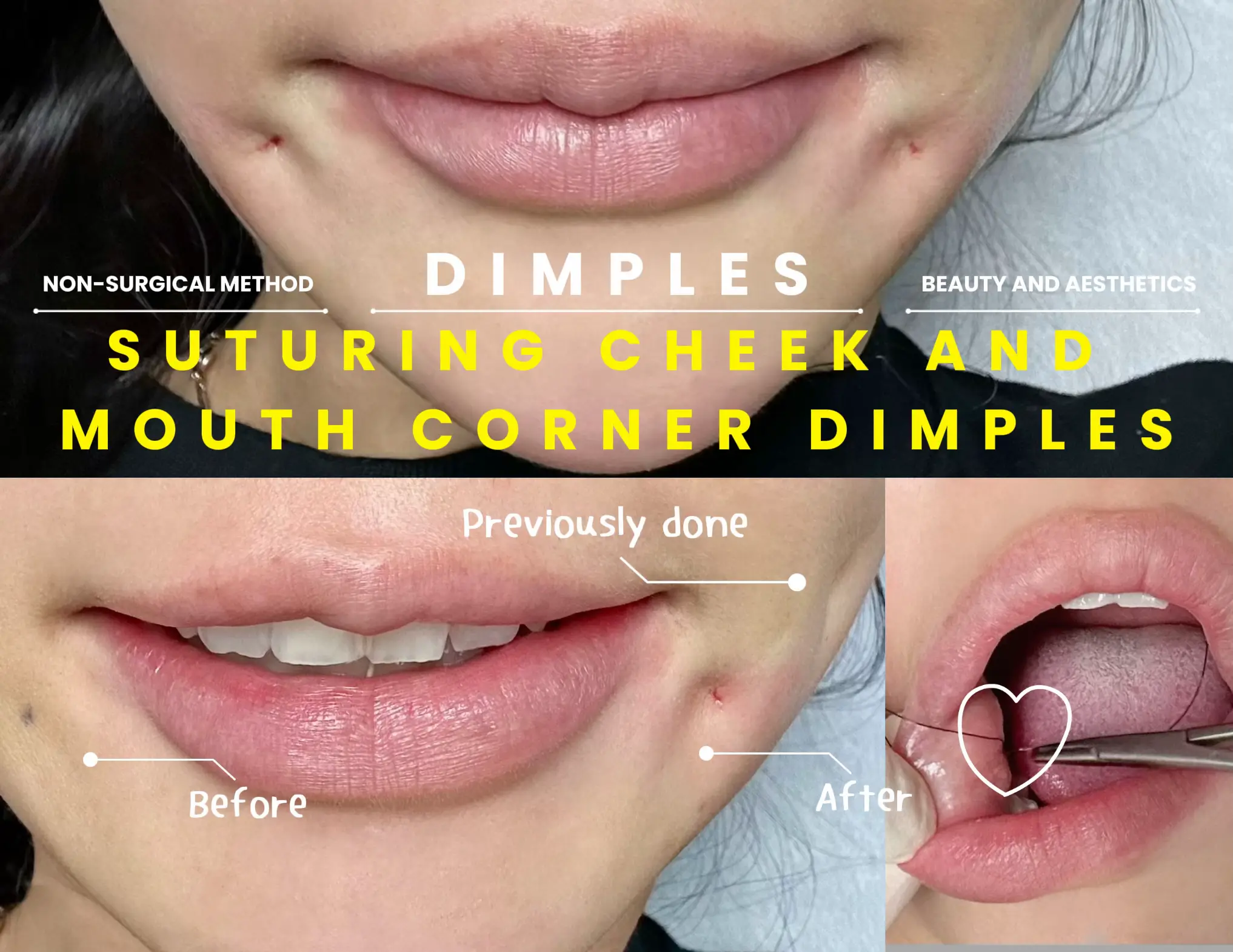 2ND EXPERIENCE WITH NON-SURGICAL DIMPLES!'s images(0)