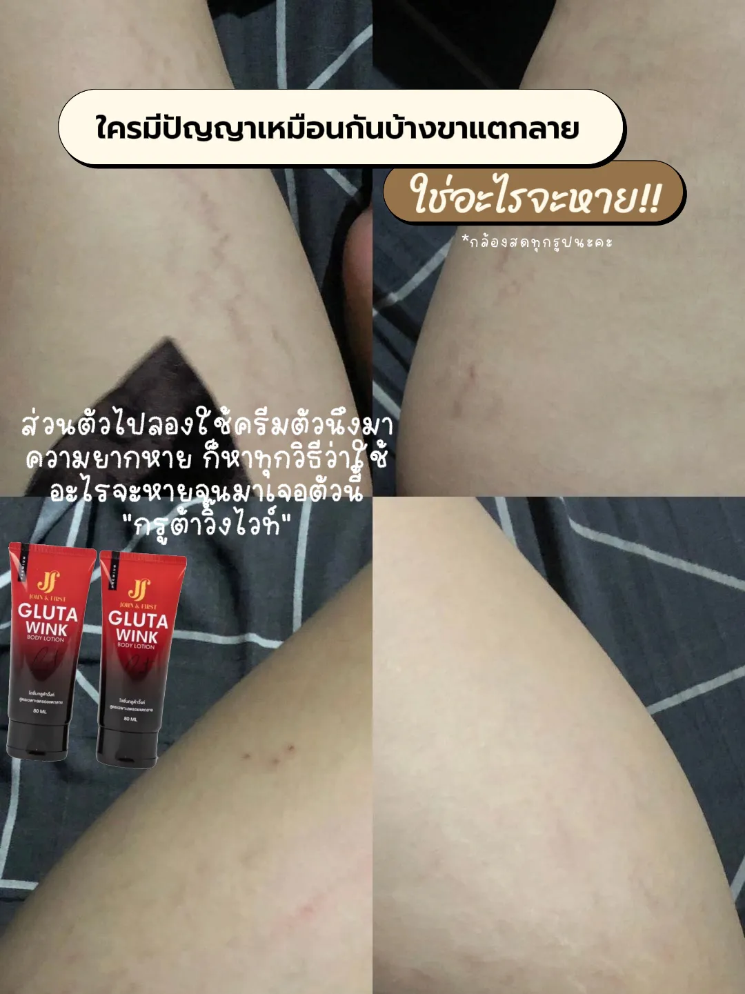 🗣️ใครมีปัญญาเหมือนกันบ้างขาแตกลาย | แกลเลอรีที่โพสต์โดย Ⓝⓞⓚⓨⓤⓝⓖ | Lemon8