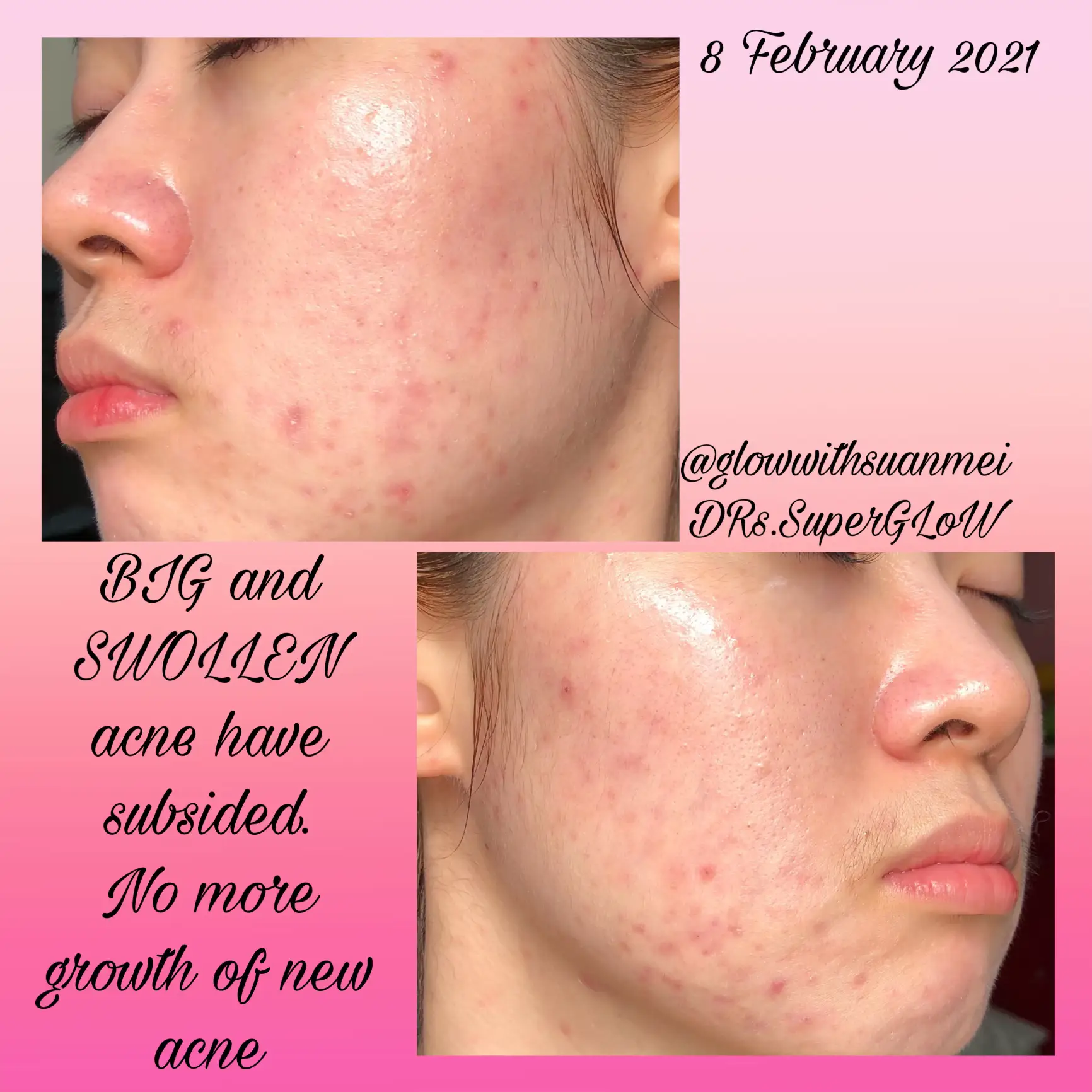 A skincare that I stick with 3 years! acne & clogs's images(4)